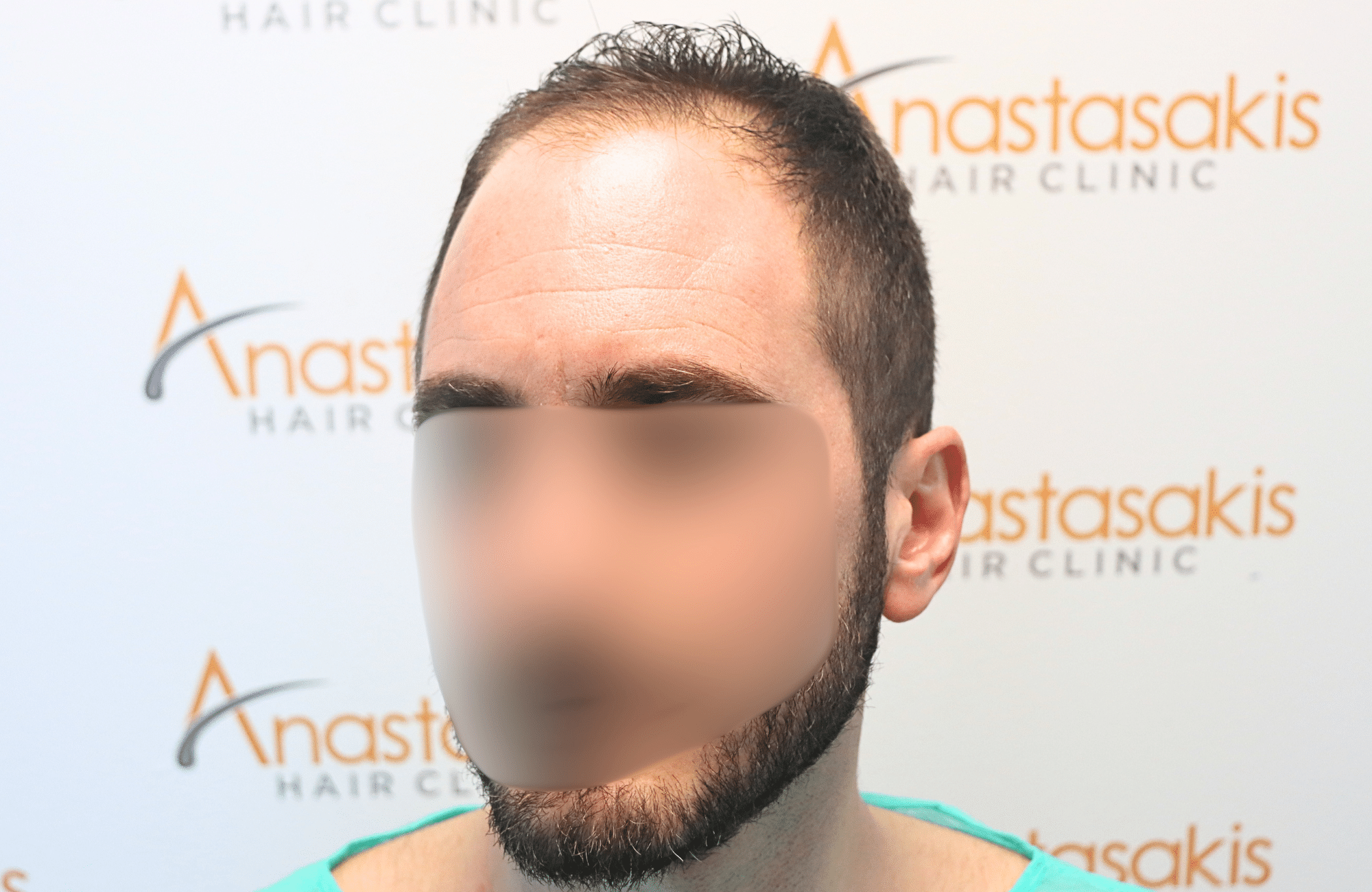 hair transplant result 2500 fus stage4