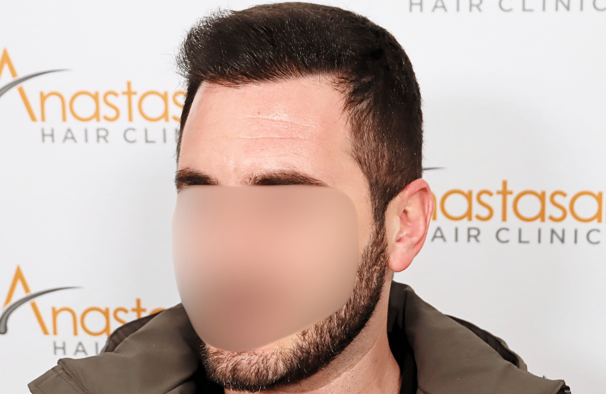 hair transplant result 2500 fus stage4