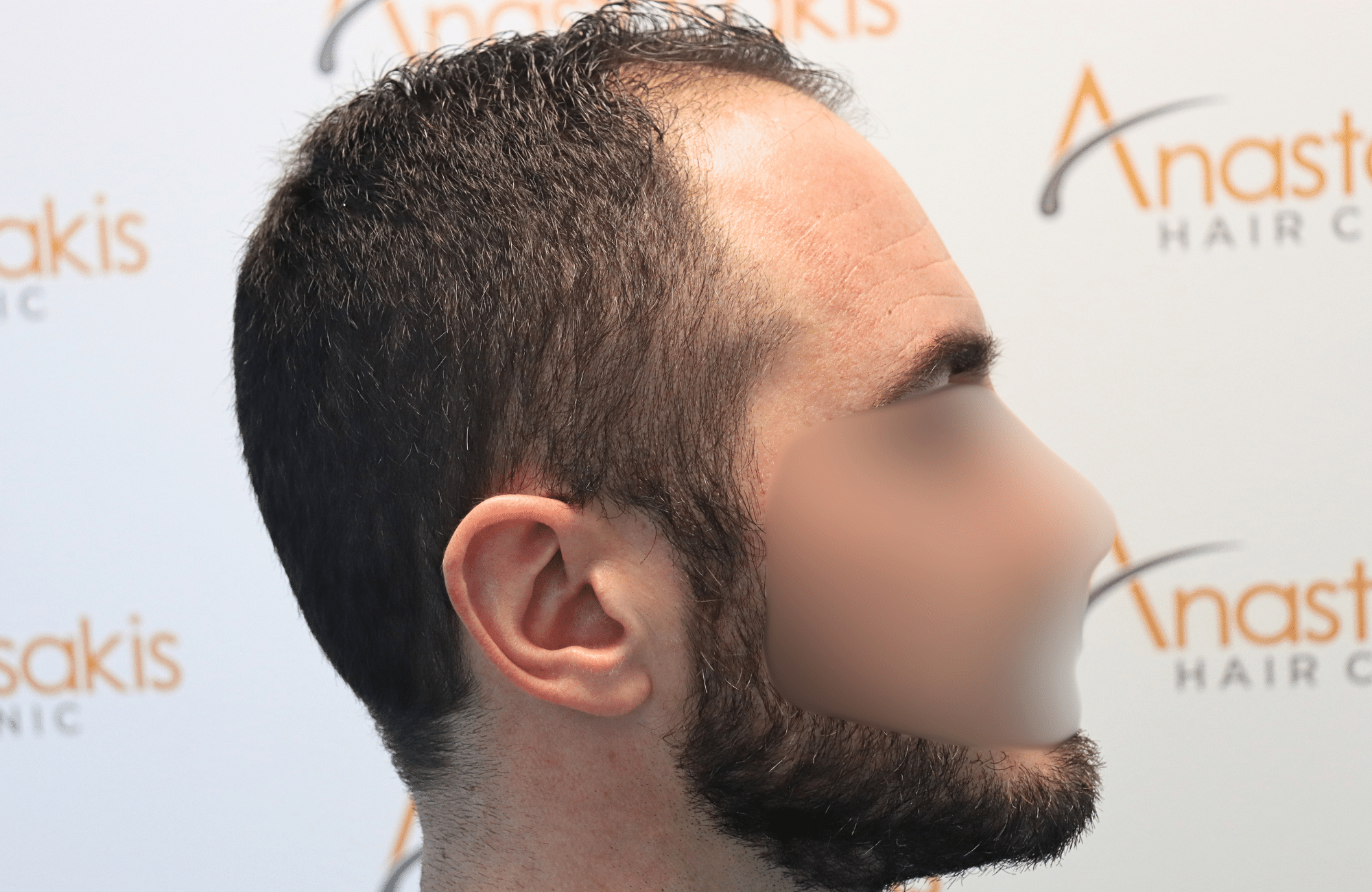 hair transplant result 2500 fus stage4