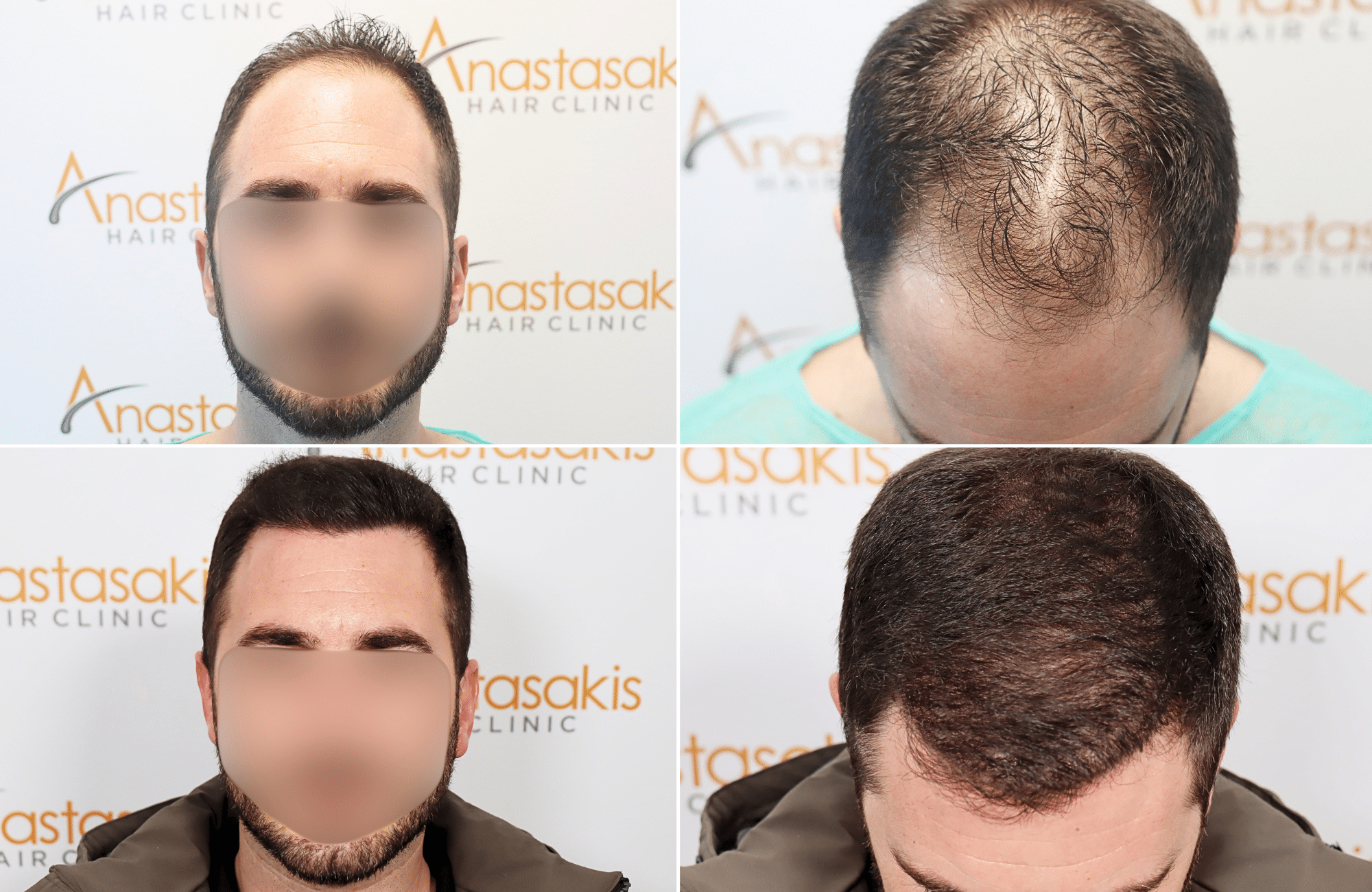 https://www.anastasakishairclinic.gr/portfolio/apotelesma-metamosxefsis-mallion-anastasakis-hair-clinic-111/