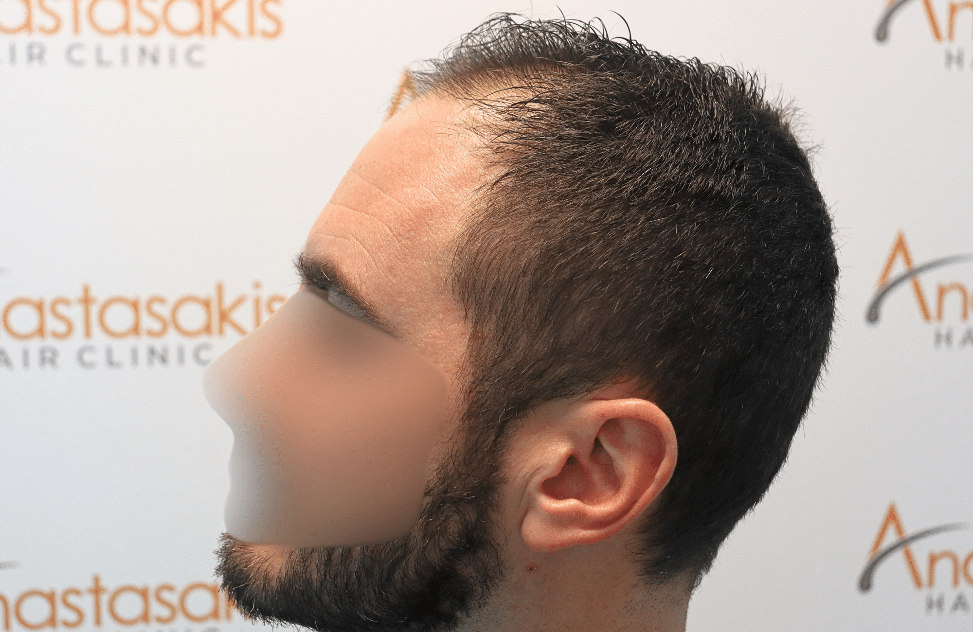 hair transplant result 2500 fus stage4