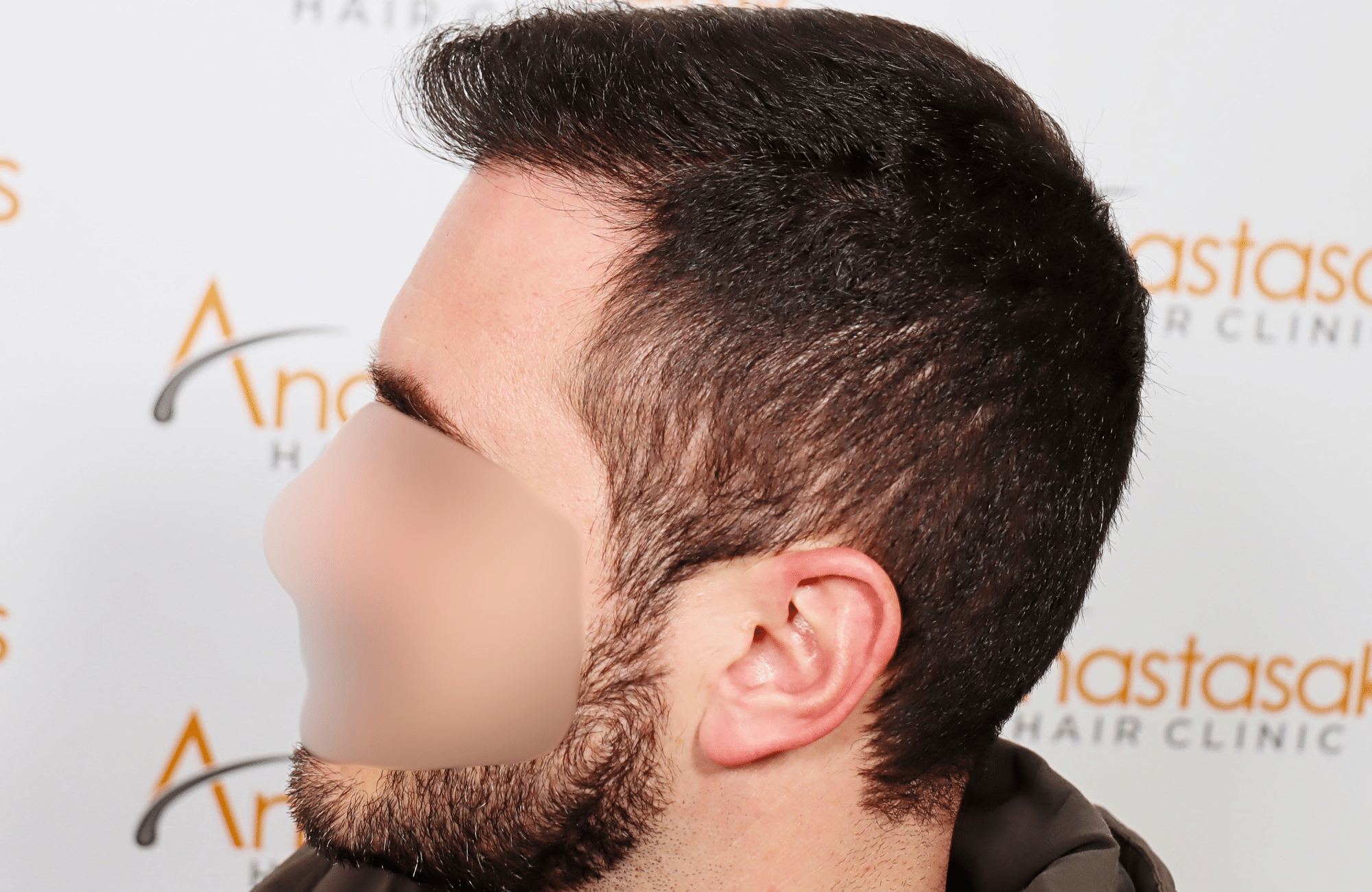hair transplant result 2500 fus stage4