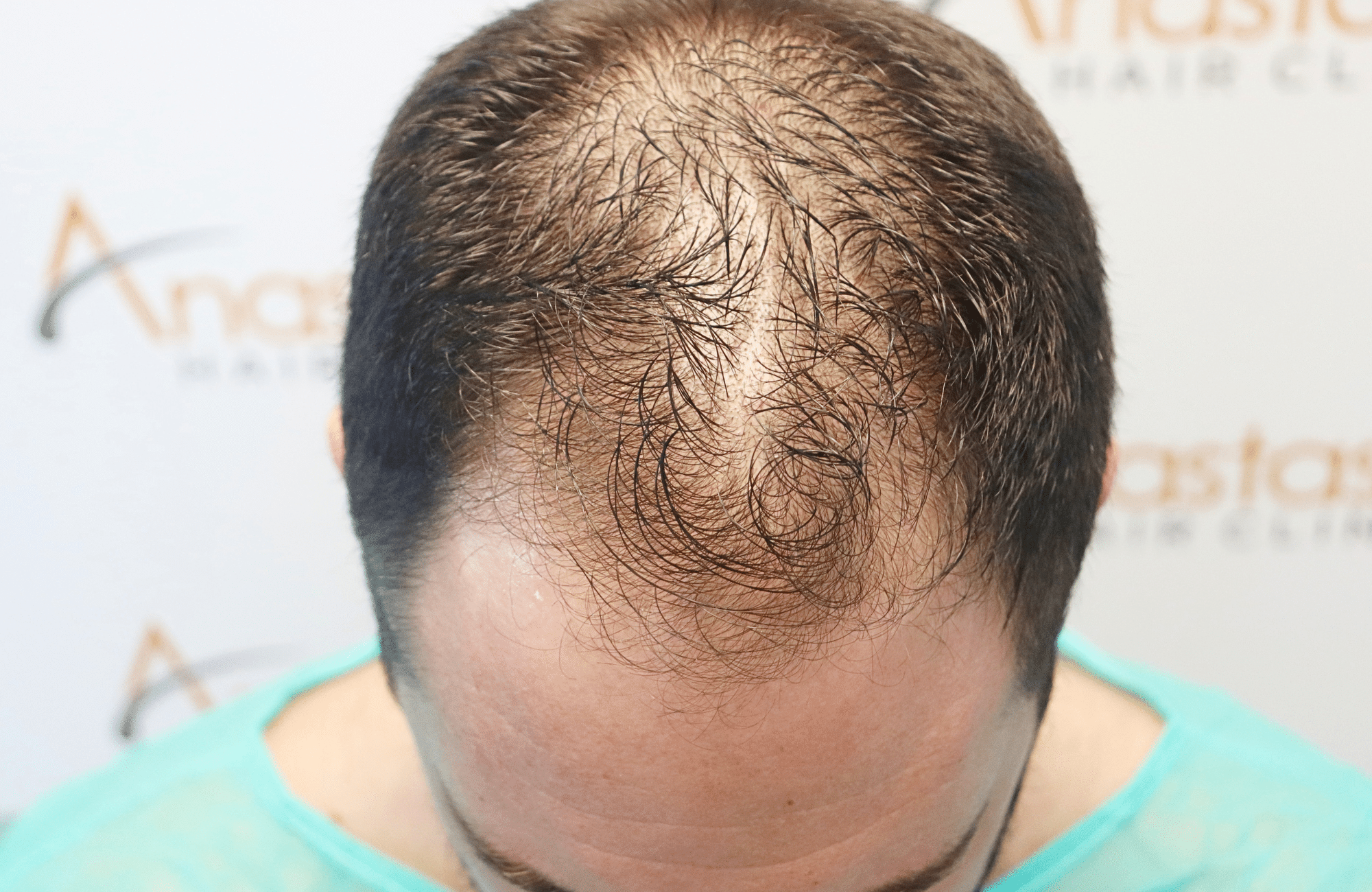 hair transplant result 2500 fus stage4
