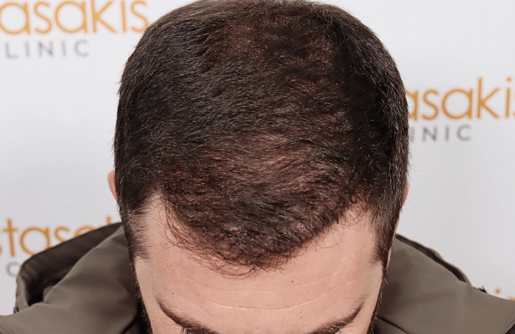 hair transplant result 2500 fus stage4