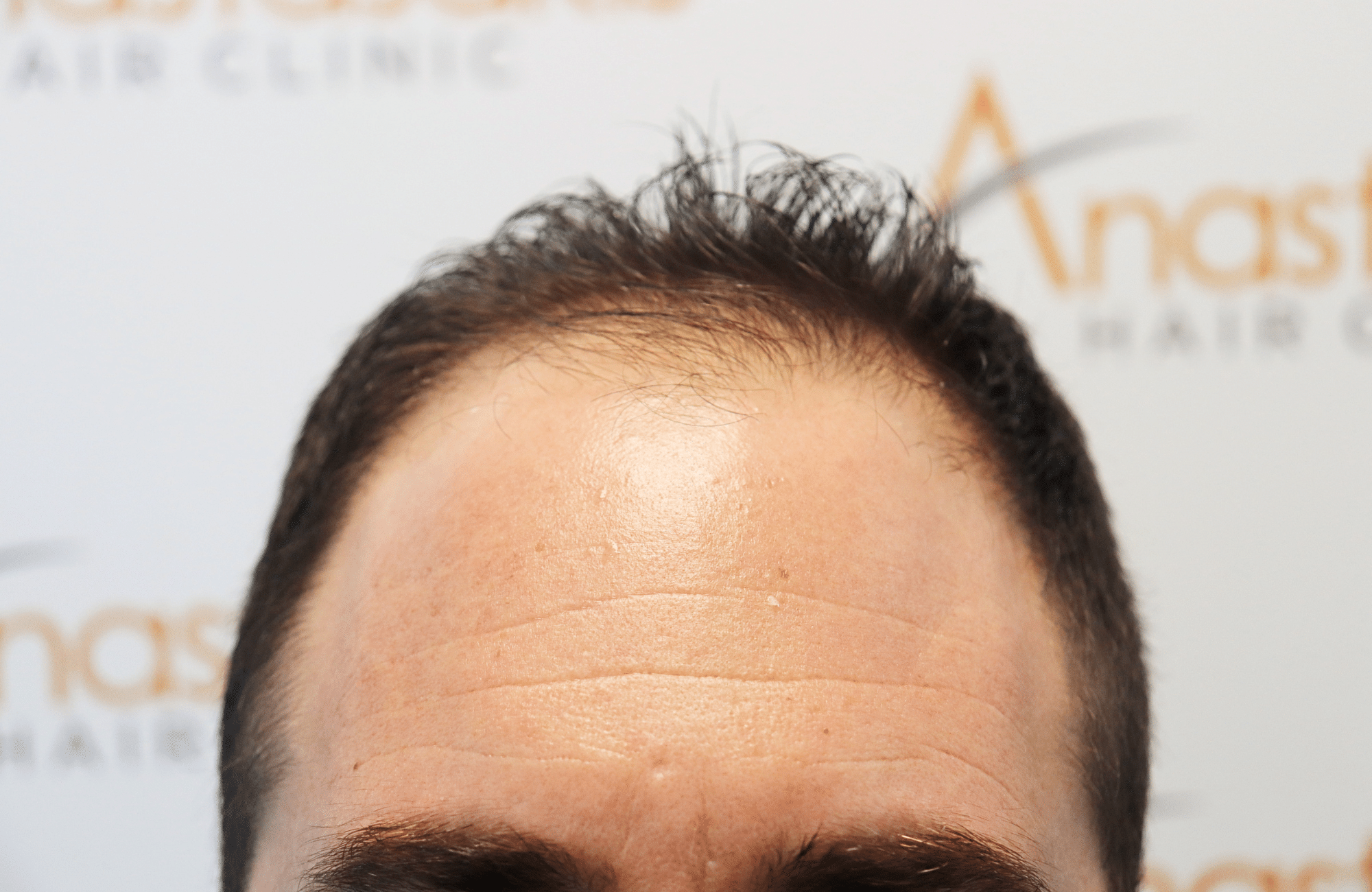 hair transplant result 2500 fus stage4