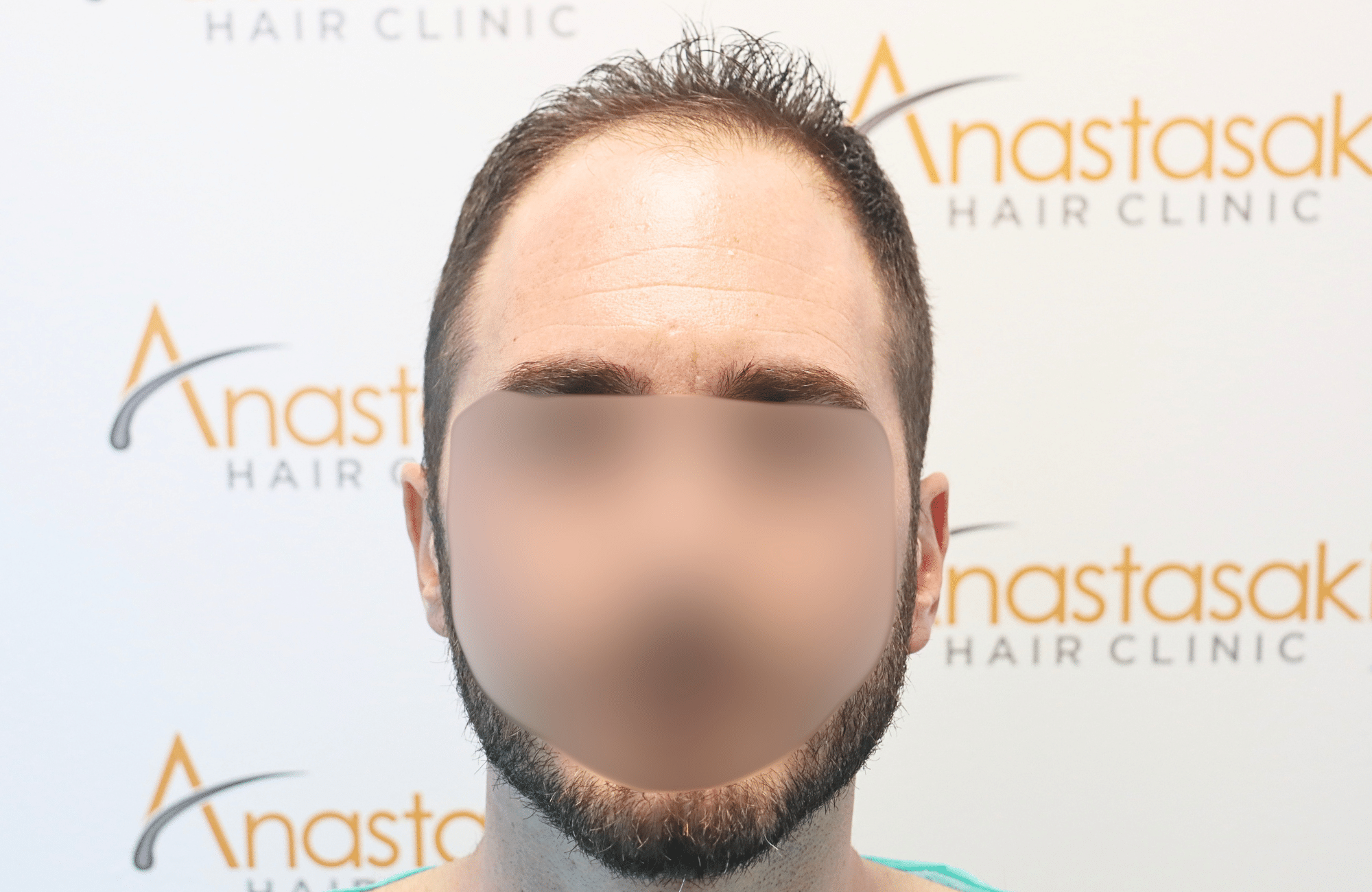 hair transplant result 2500 fus stage4