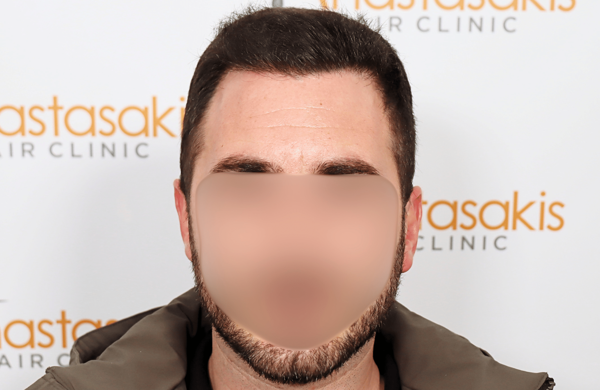 hair transplant result 2500 fus stage4