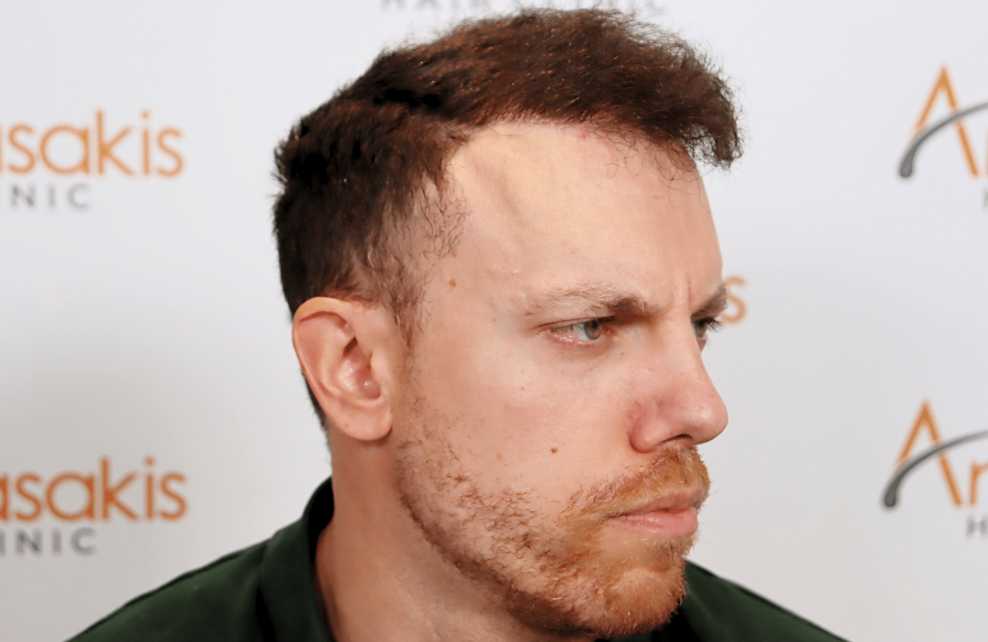 hair transplant result 2600 fus stage 5 1st stage light thick
