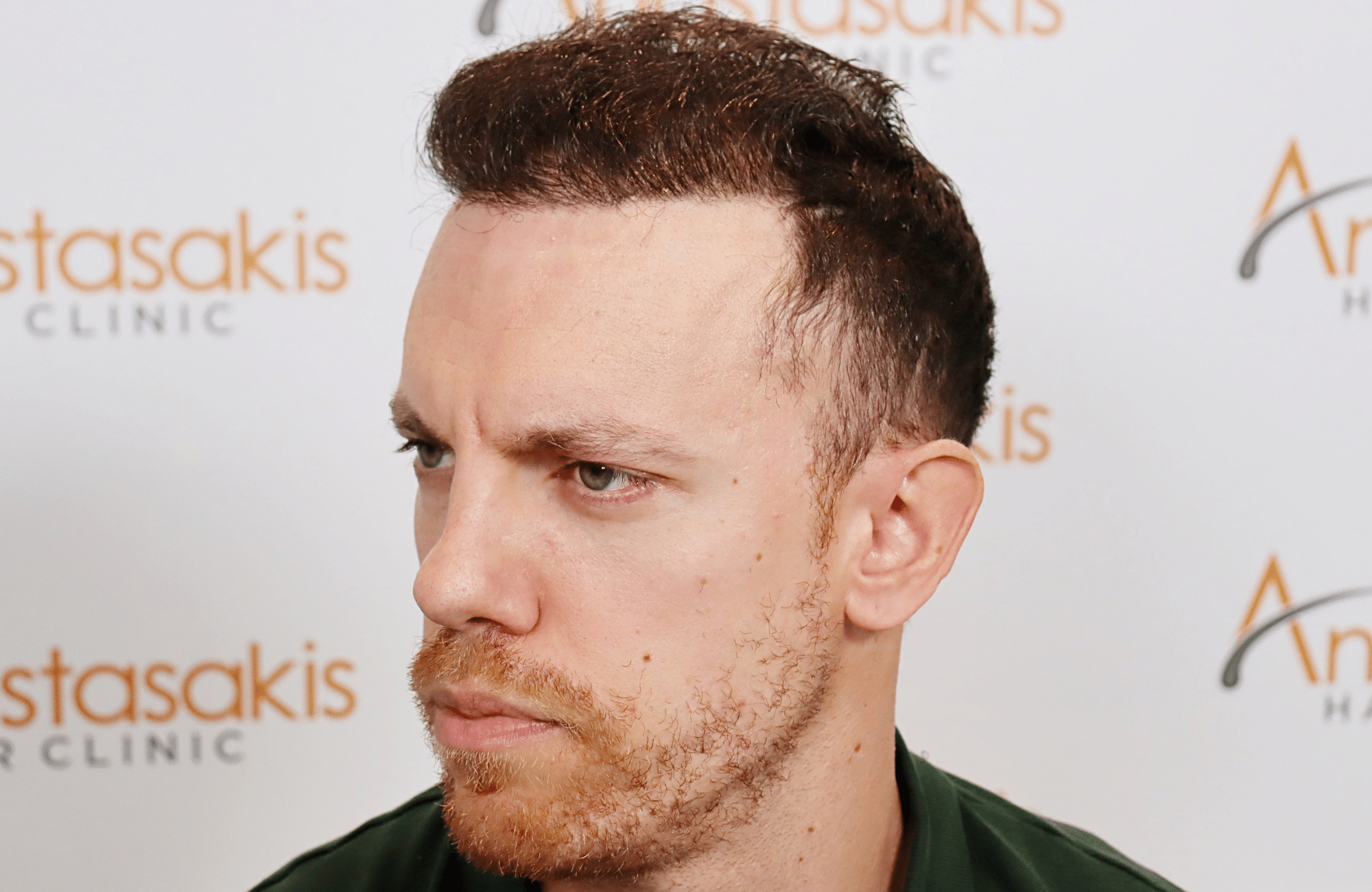 hair transplant result 2600 fus stage 5 1st stage light thick