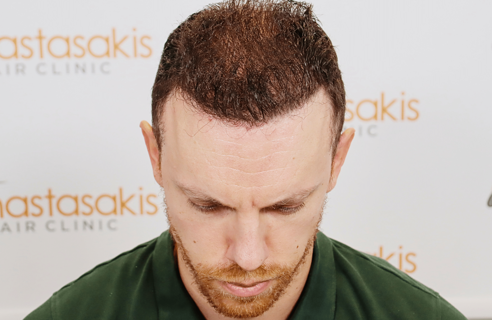 hair transplant result 2600 fus stage 5 1st stage light thick