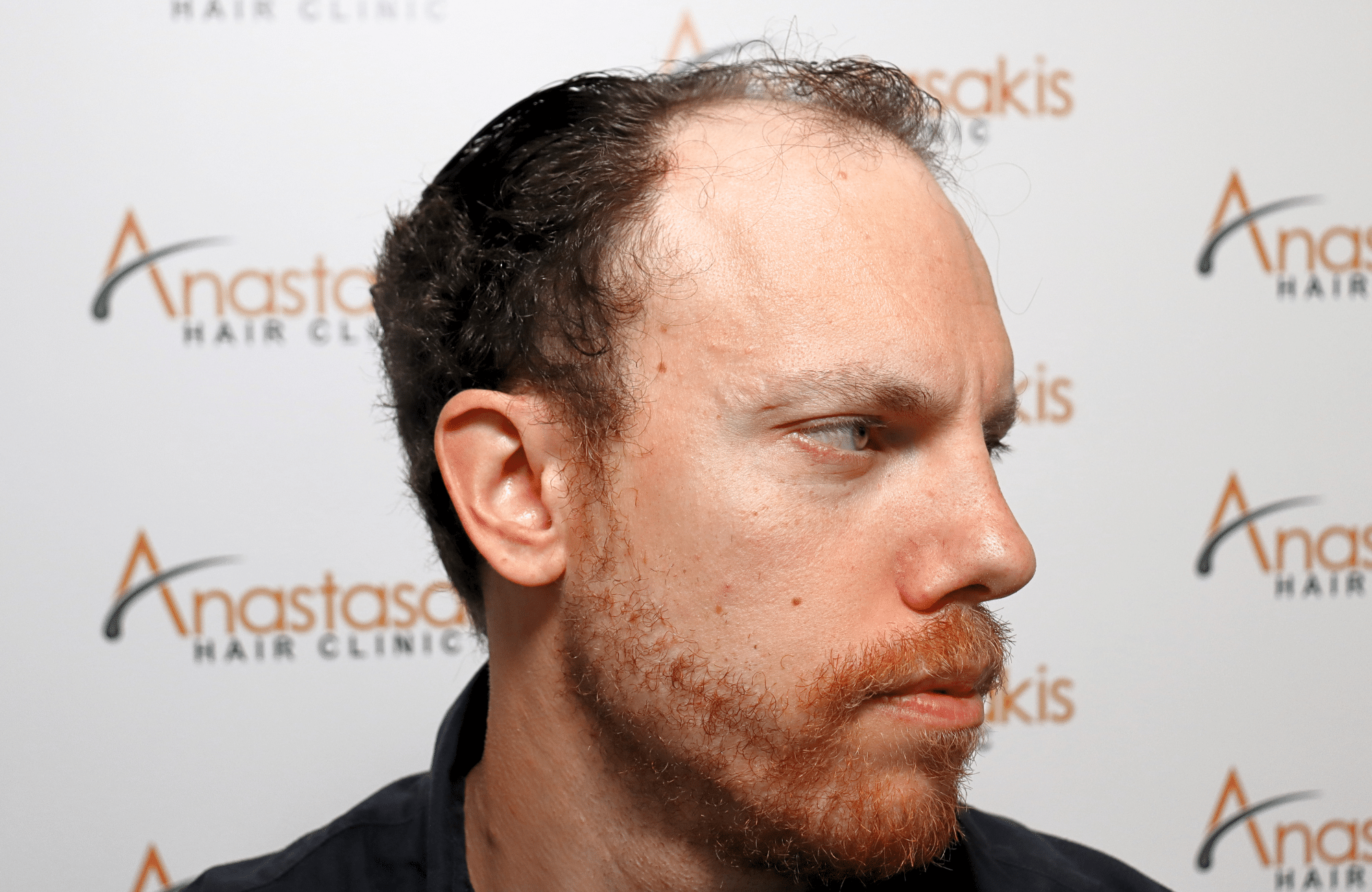 hair transplant result 2600 fus stage 5 1st stage light thick