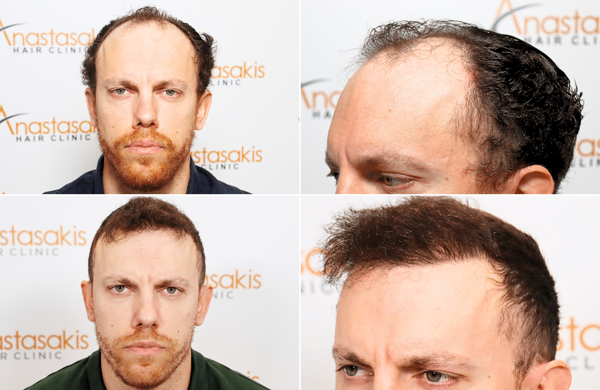 https://www.anastasakishairclinic.gr/portfolio/apotelesma-metamosxefsis-mallion-anastasakis-hair-clinic-104/