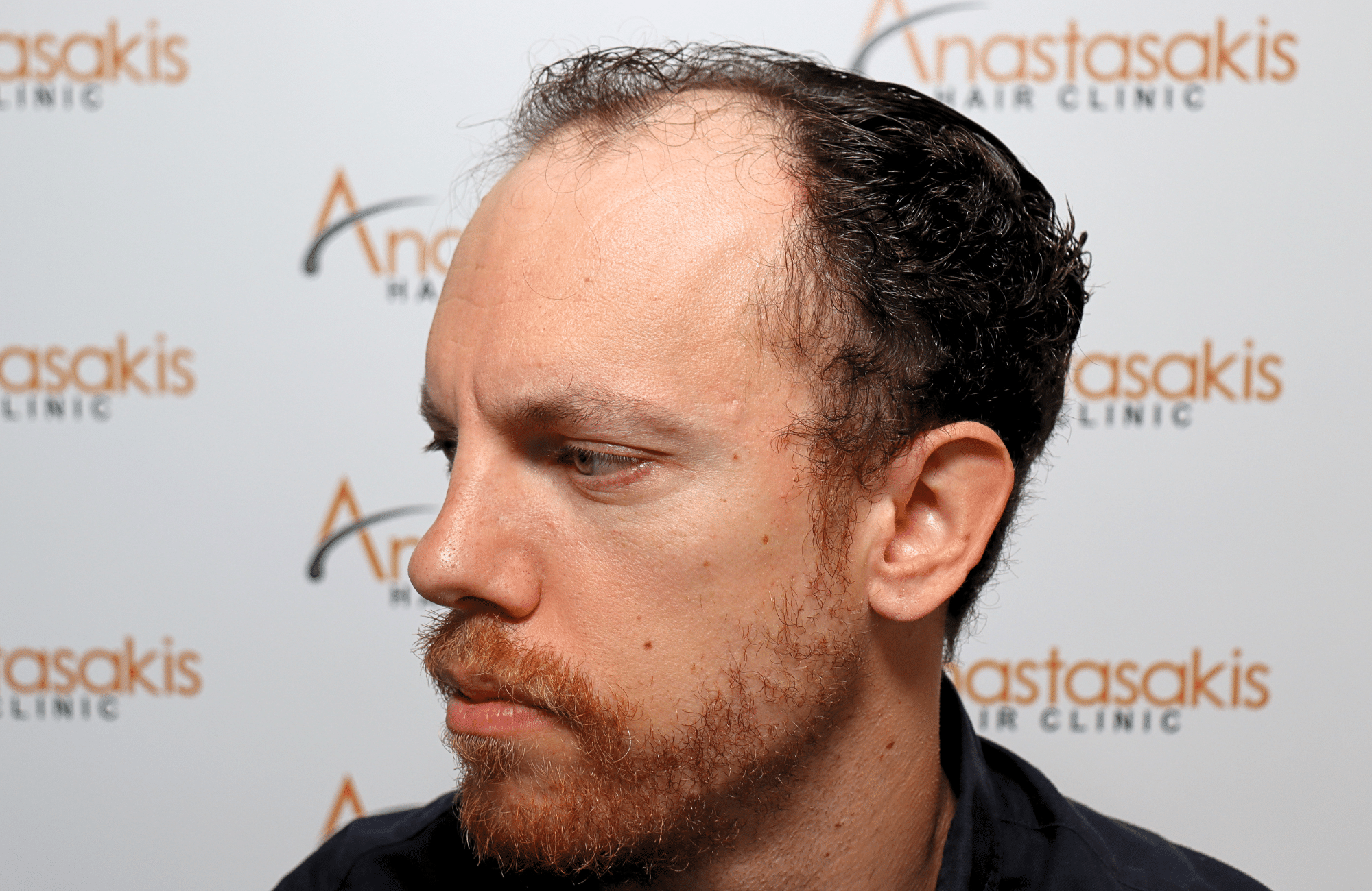 hair transplant result 2600 fus stage 5 1st stage light thick