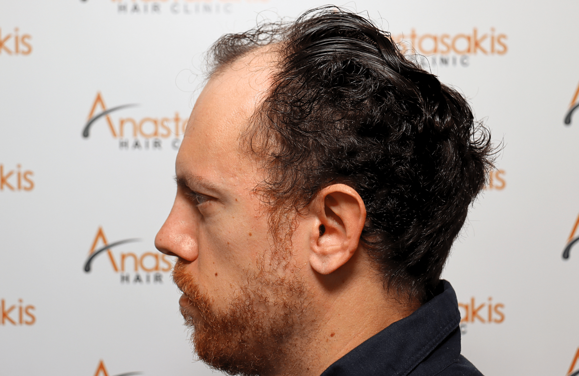 hair transplant result 2600 fus stage 5 1st stage light thick