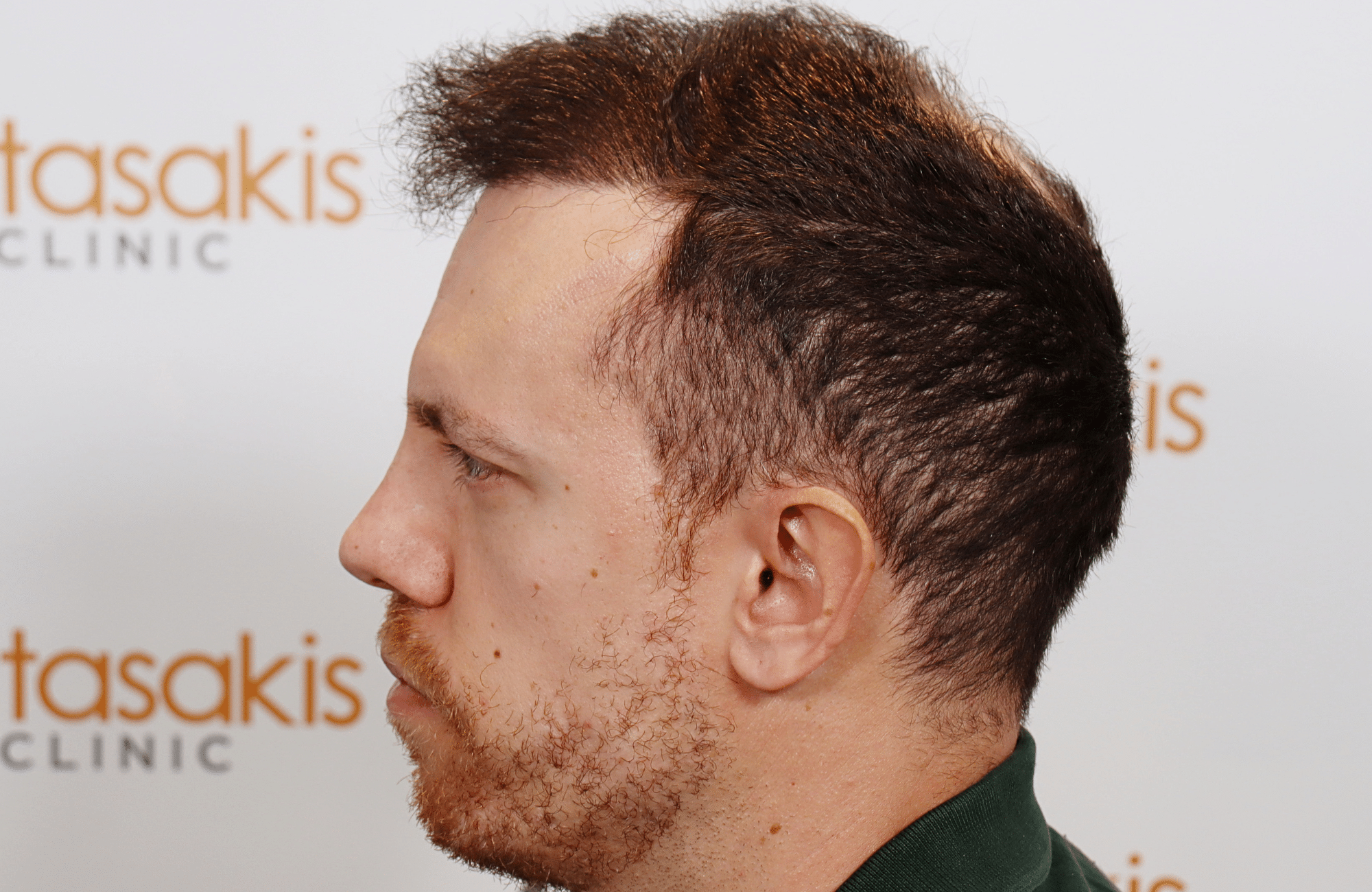 hair transplant result 2600 fus stage 5 1st stage light thick