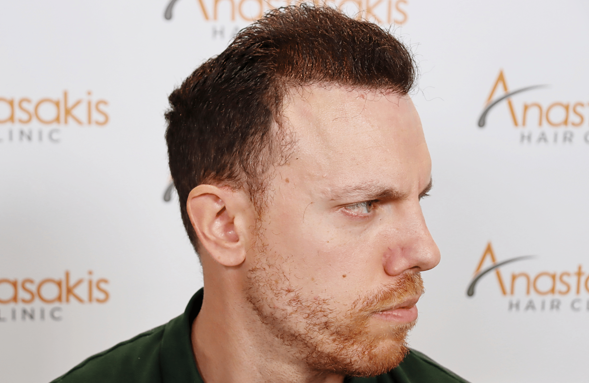 hair transplant result 2600 fus stage 5 1st stage light thick