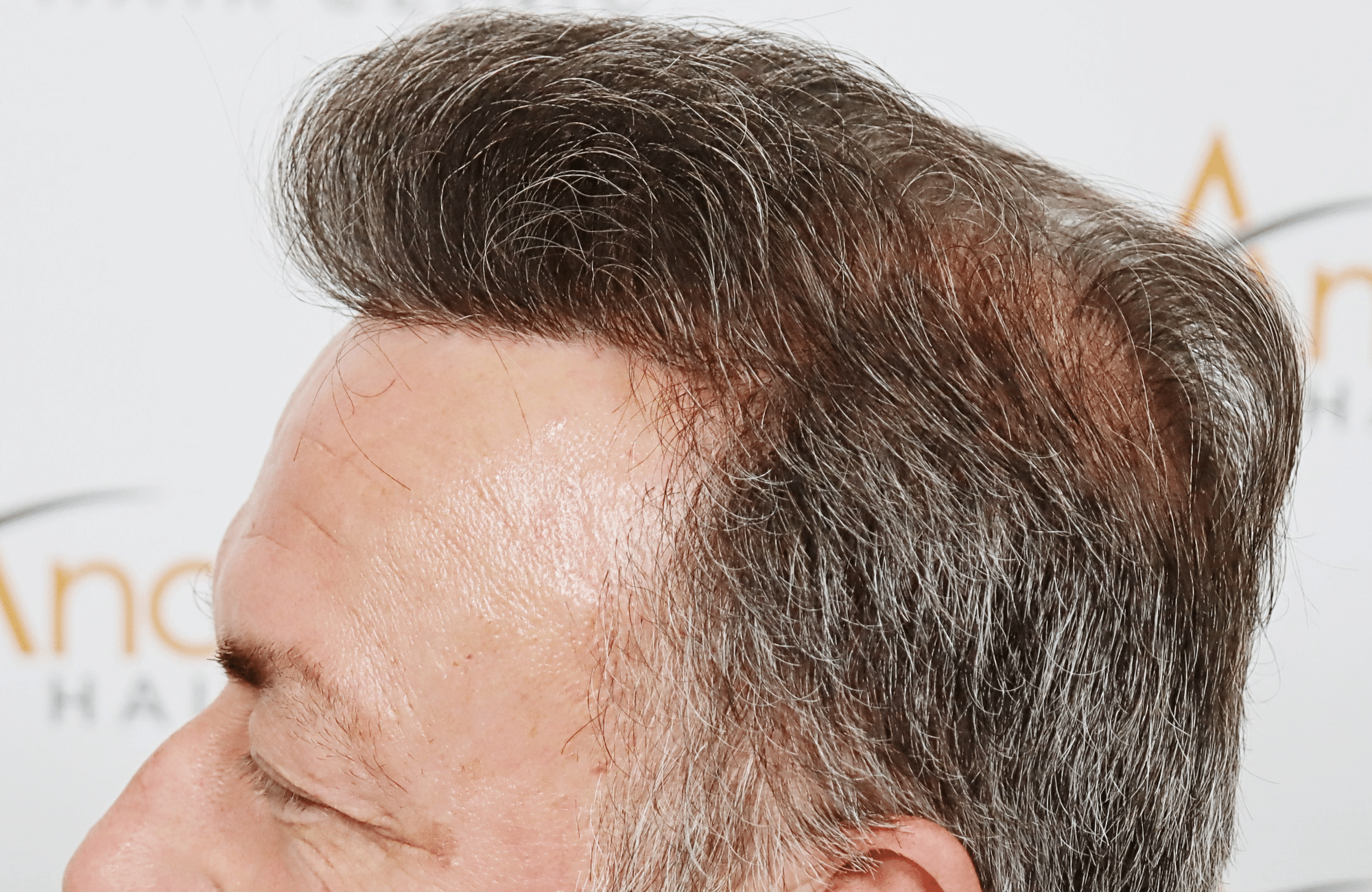 hair transplant result 3700 fus frontal stage 5