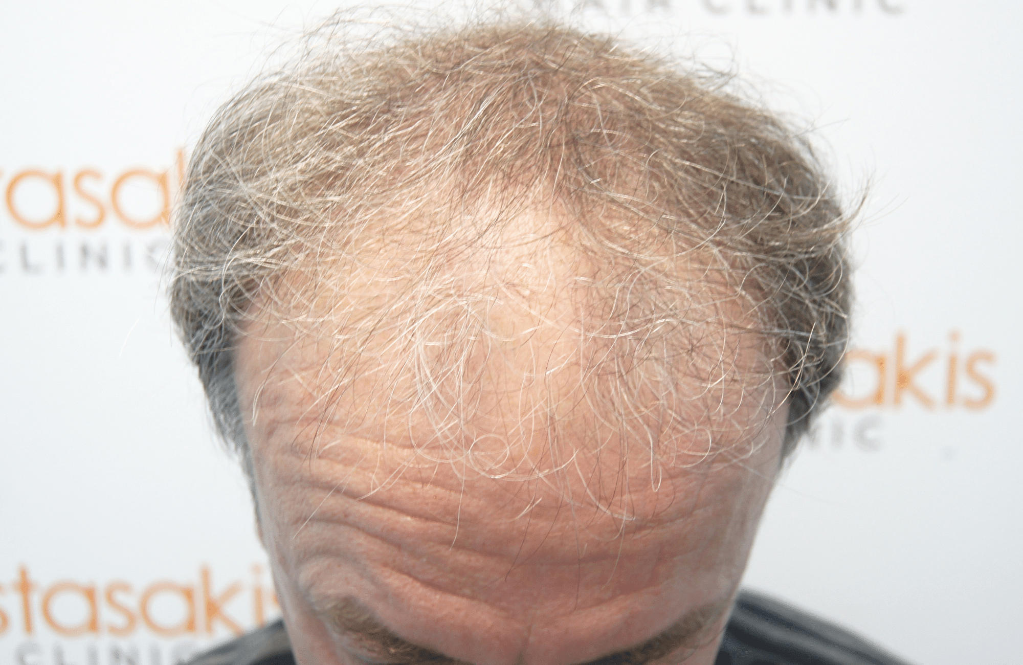 hair transplant result 3700 fus frontal stage 5