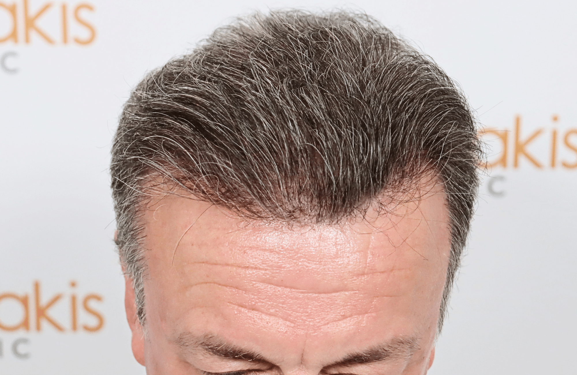 hair transplant result 3700 fus frontal stage 5