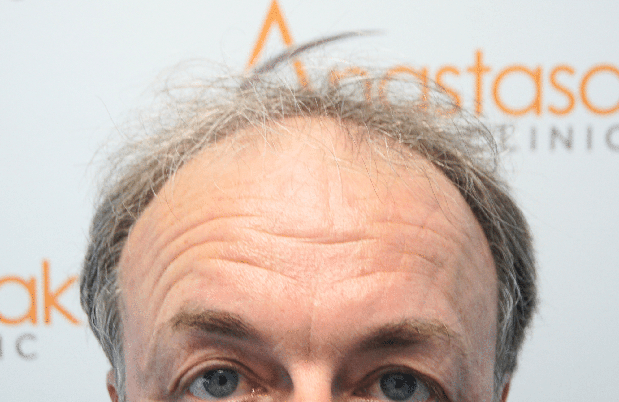hair transplant result 3700 fus frontal stage 5