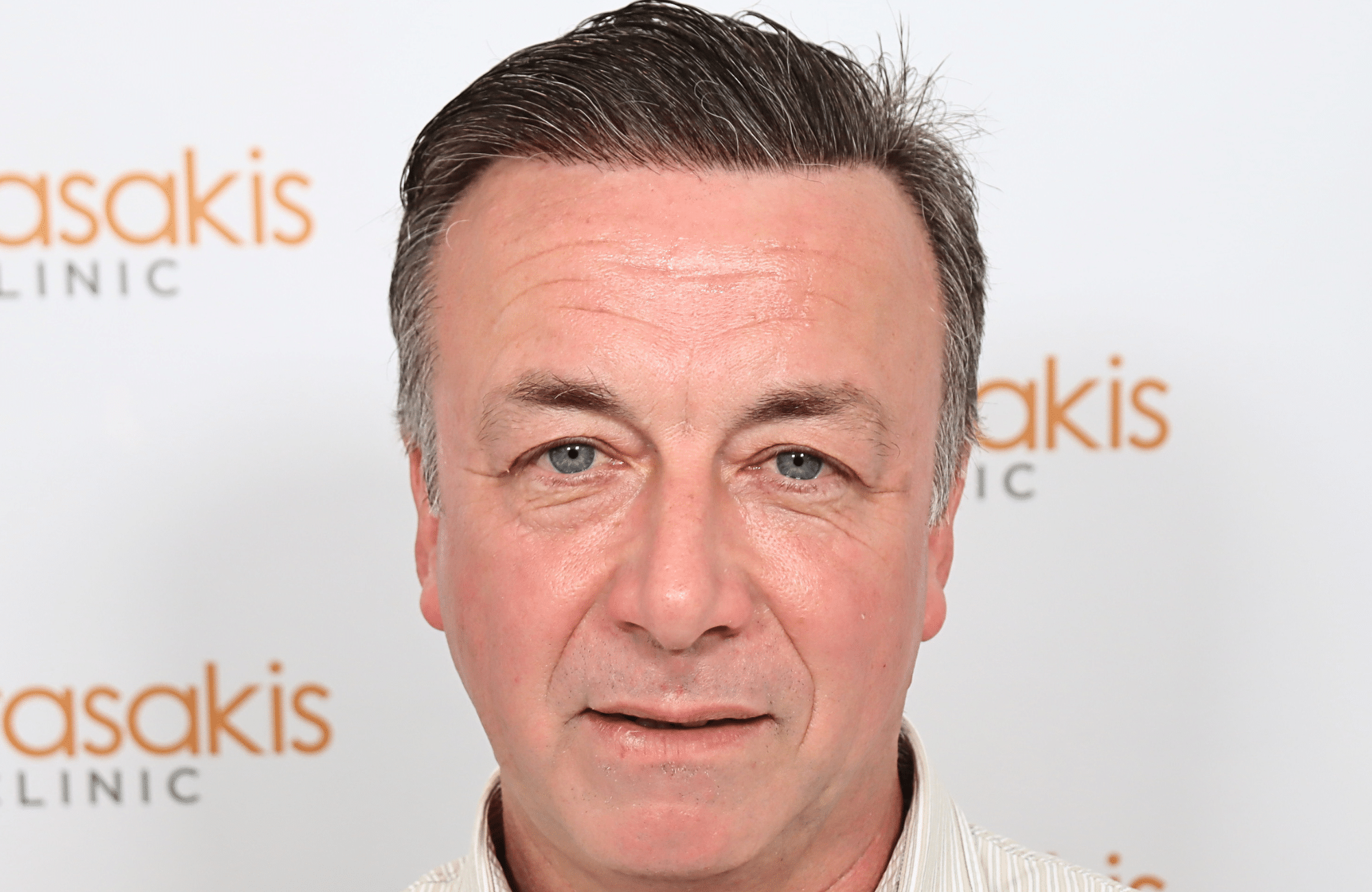 hair transplant result 3700 fus frontal stage 5