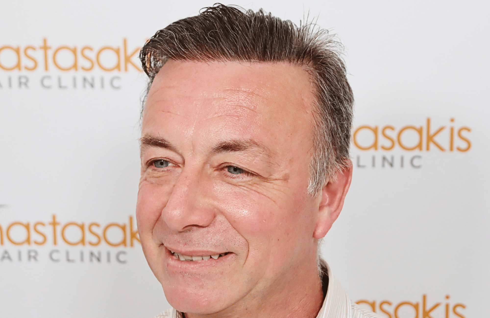 hair transplant result 3700 fus frontal stage 5