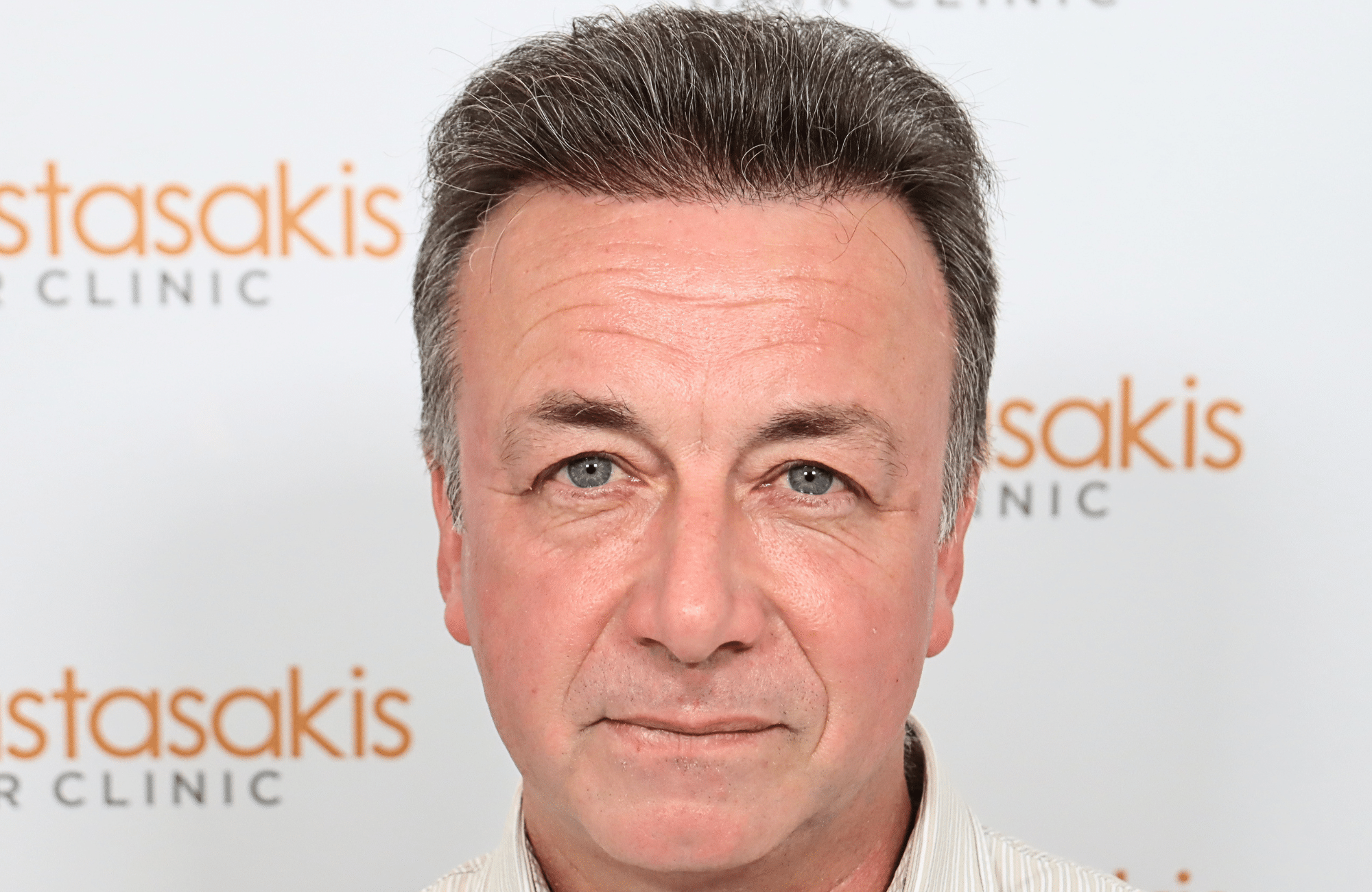 hair transplant result 3700 fus frontal stage 5