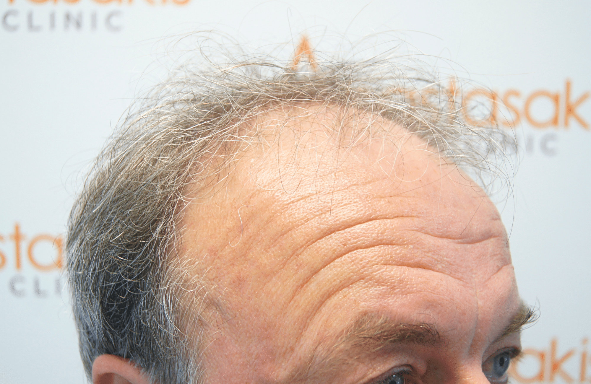 hair transplant result 3700 fus frontal stage 5