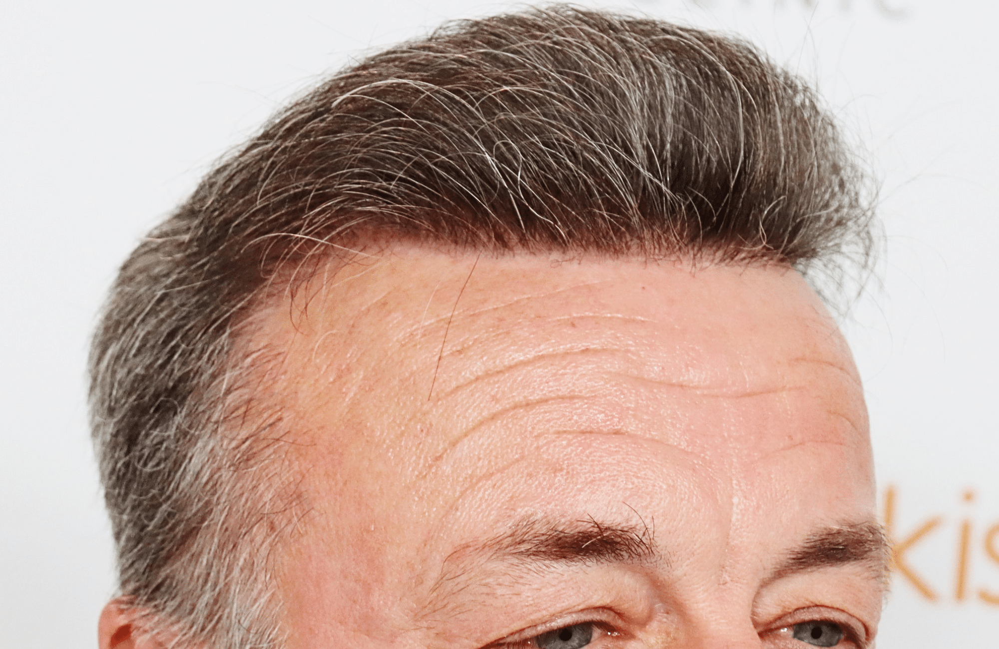 hair transplant result 3700 fus frontal stage 5