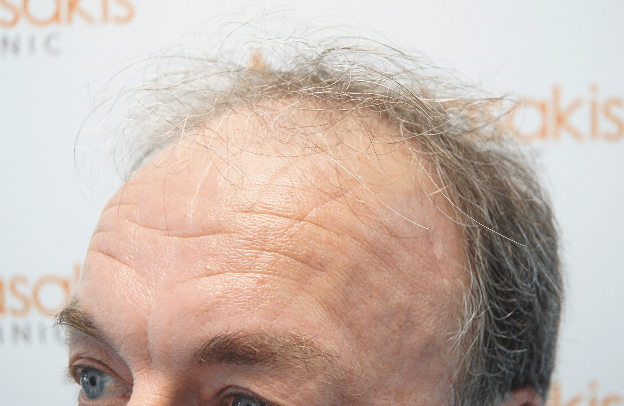 hair transplant result 3700 fus frontal stage 5