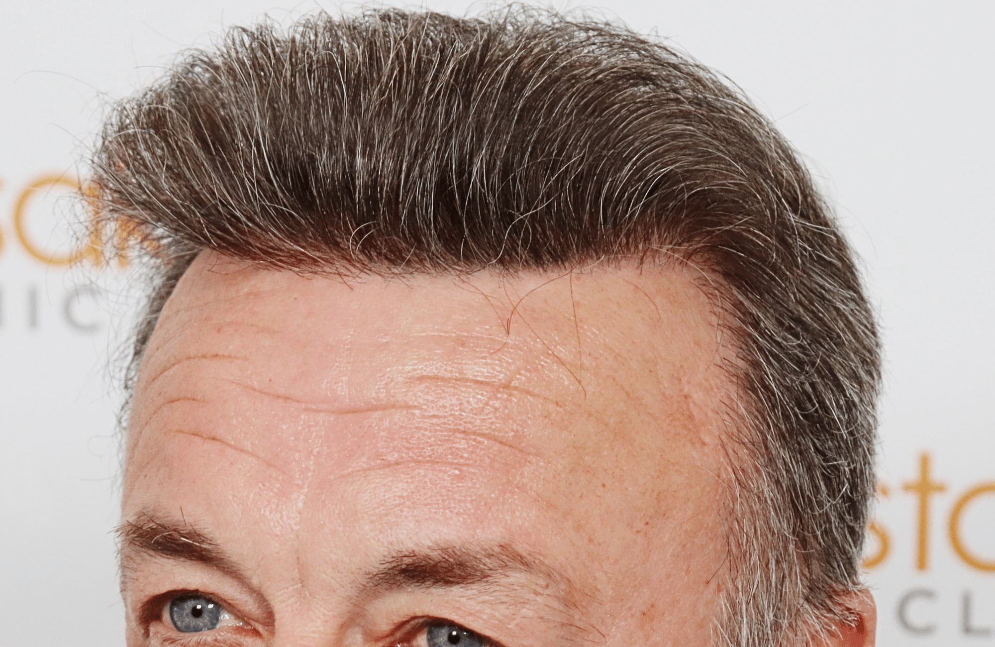 hair transplant result 3700 fus frontal stage 5