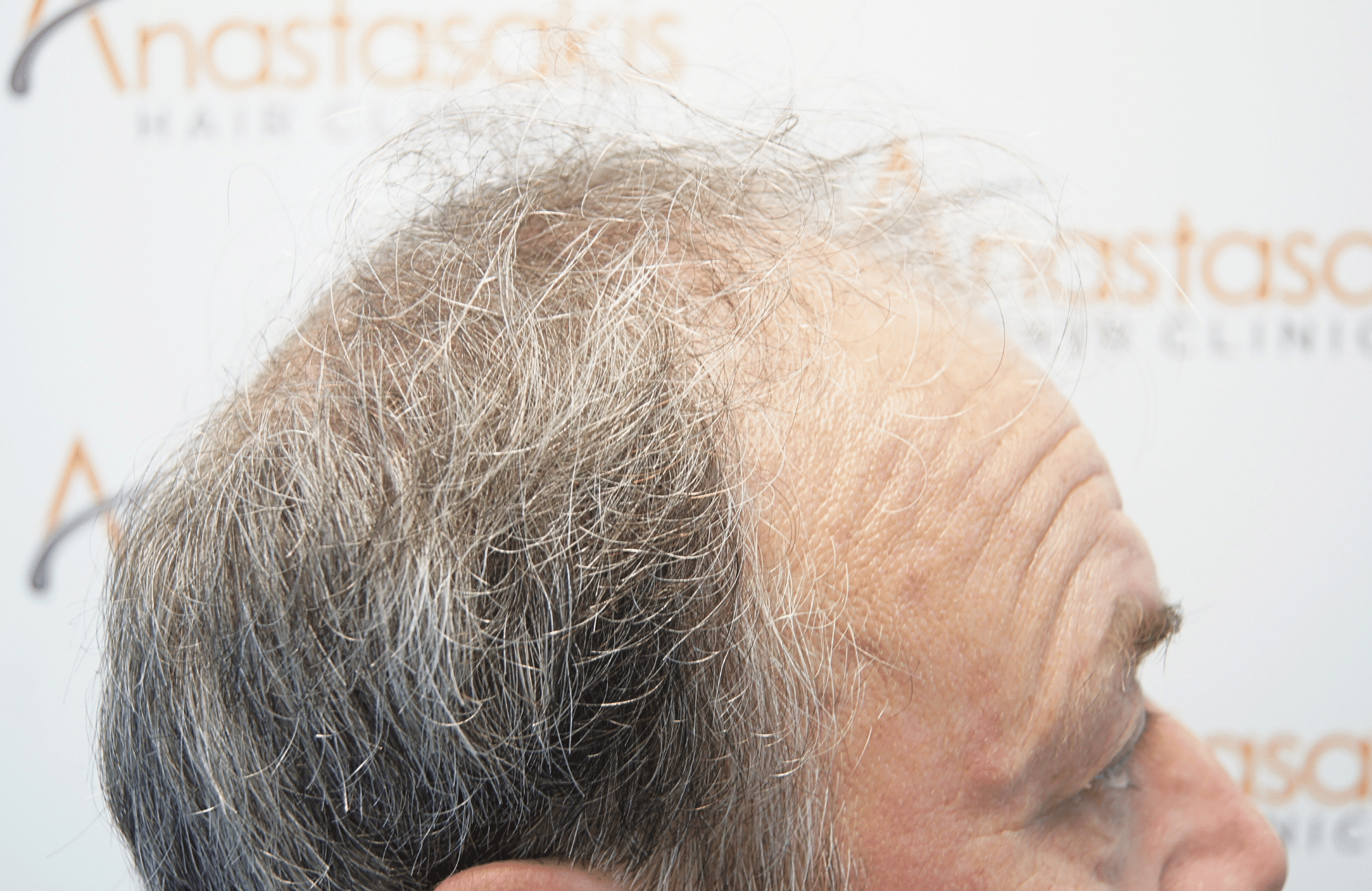 hair transplant result 3700 fus frontal stage 5