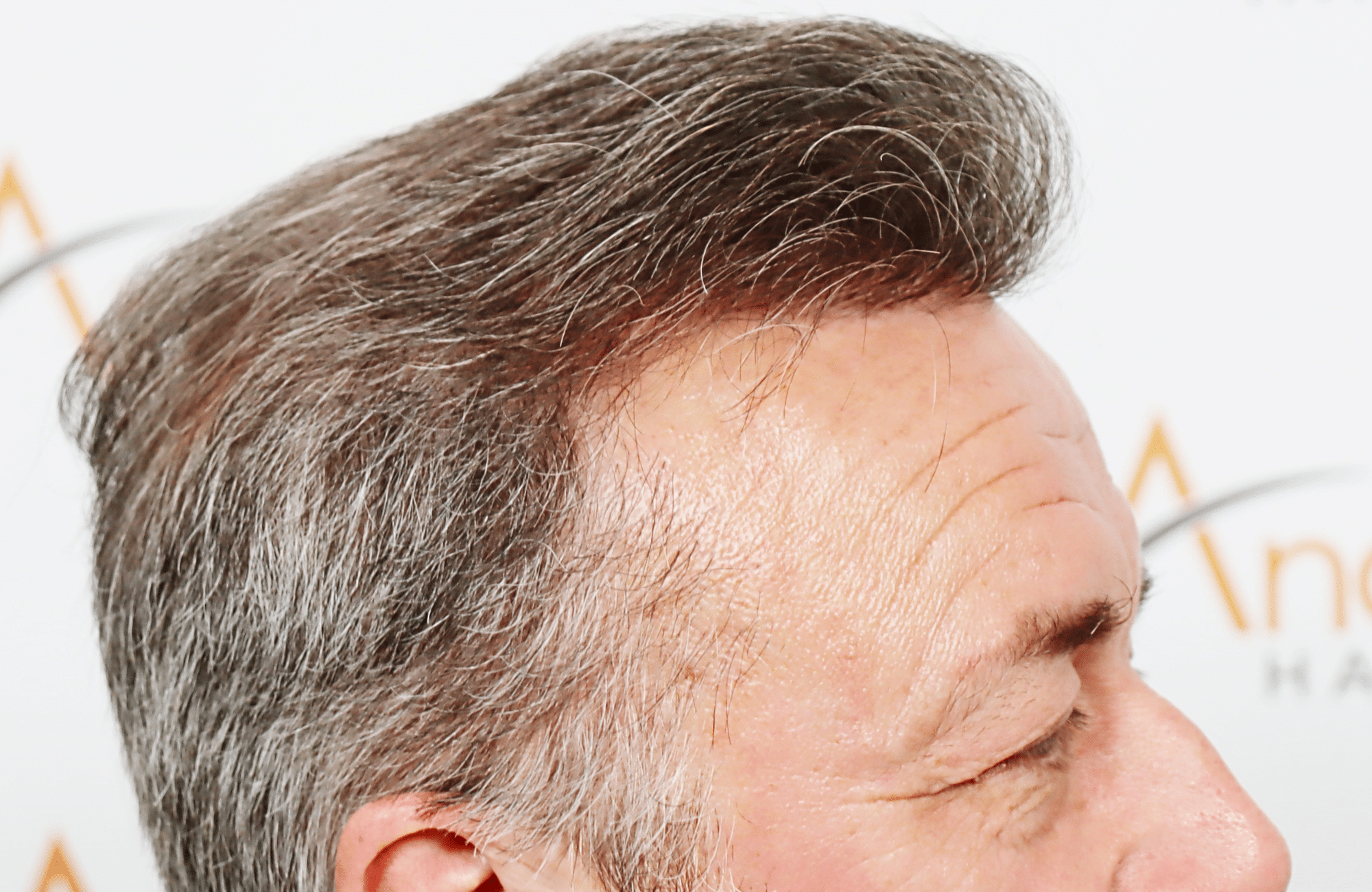 hair transplant result 3700 fus frontal stage 5