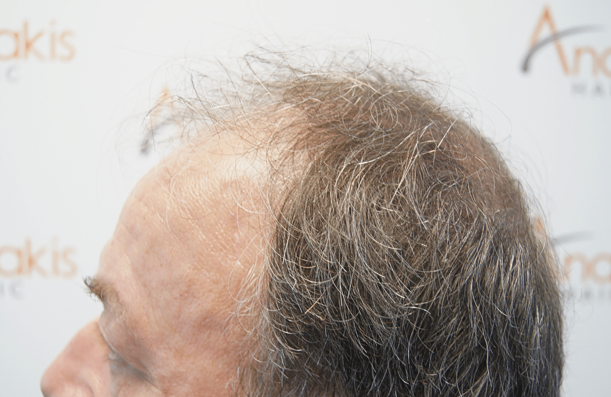 hair transplant result 3700 fus frontal stage 5
