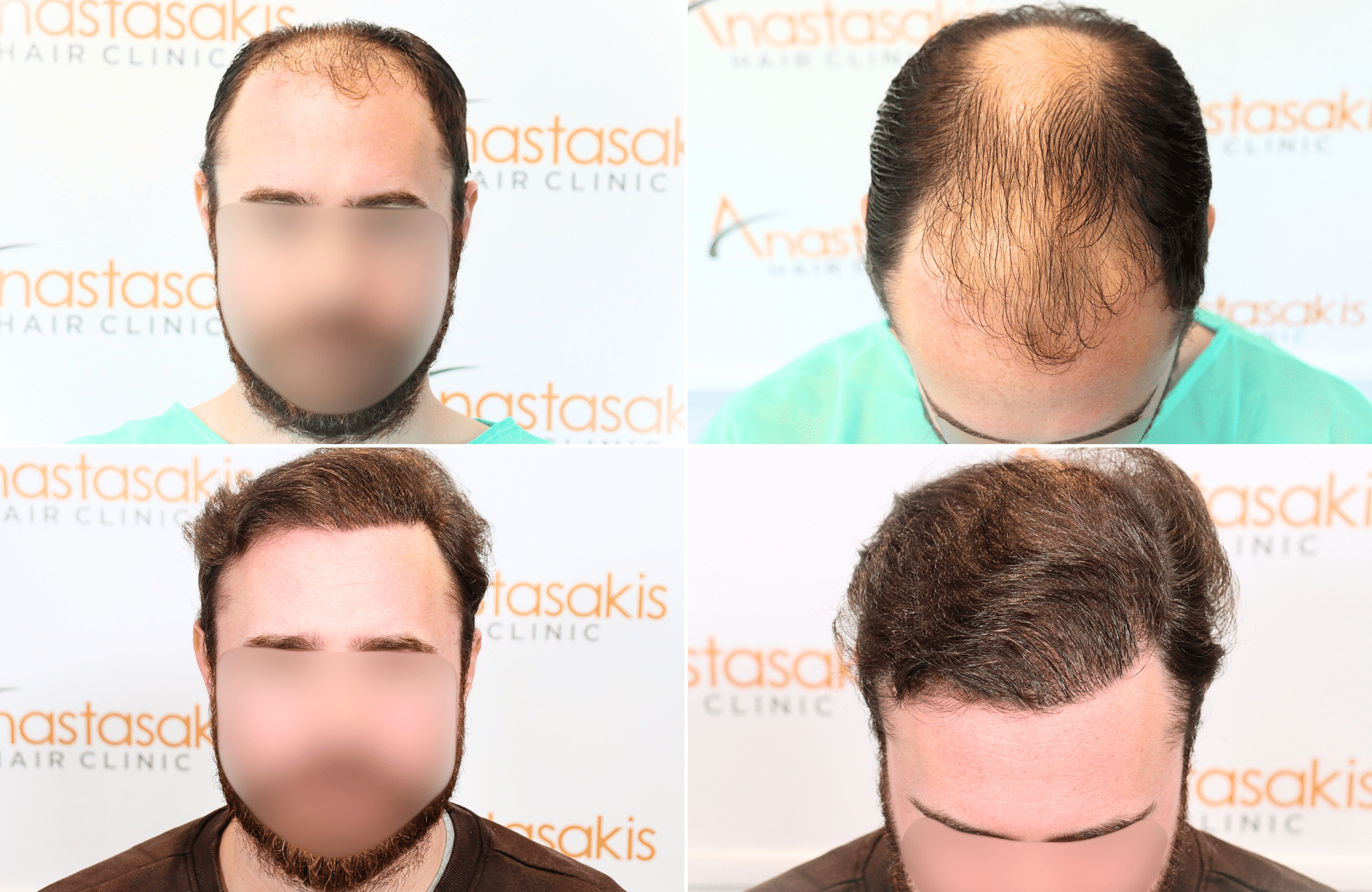 https://www.anastasakishairclinic.gr/portfolio/apotelesma-metamosxefsis-mallion-anastasakis-hair-clinic-152/