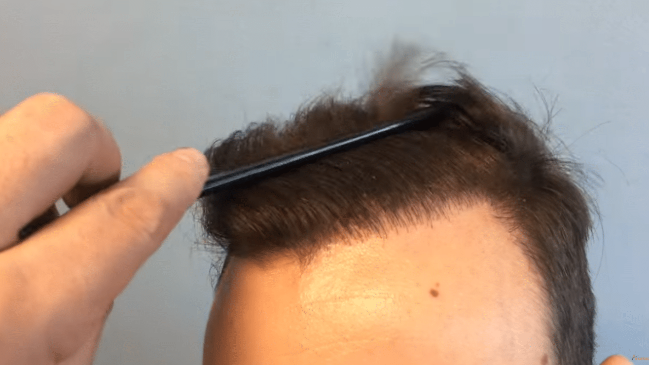 hairline φυσικο με 2500 τριχοθυλακια