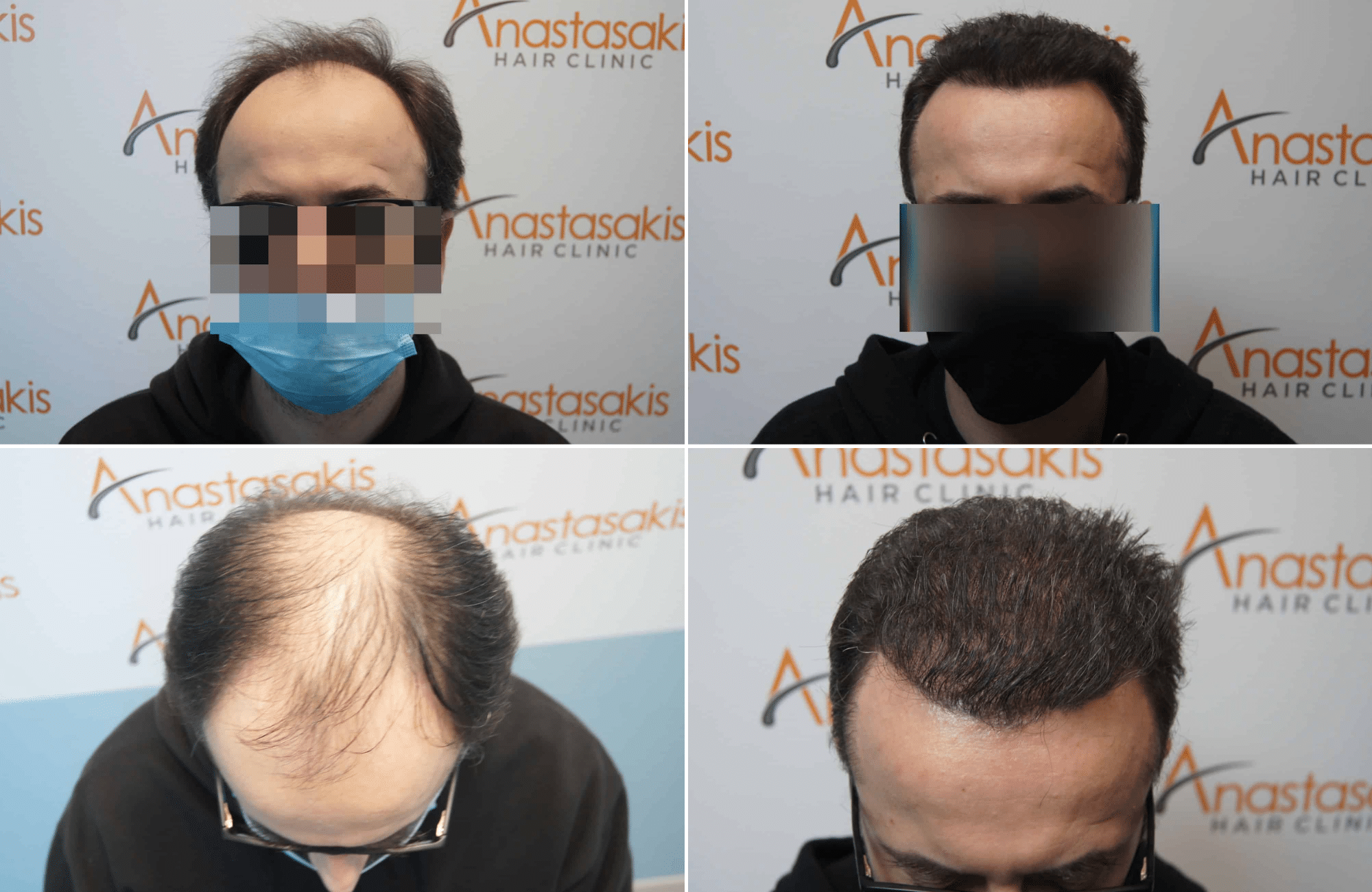https://www.anastasakishairclinic.gr/portfolio/apotelesma-metamosxefsis-mallion-anastasakis-hair-clinic-340/