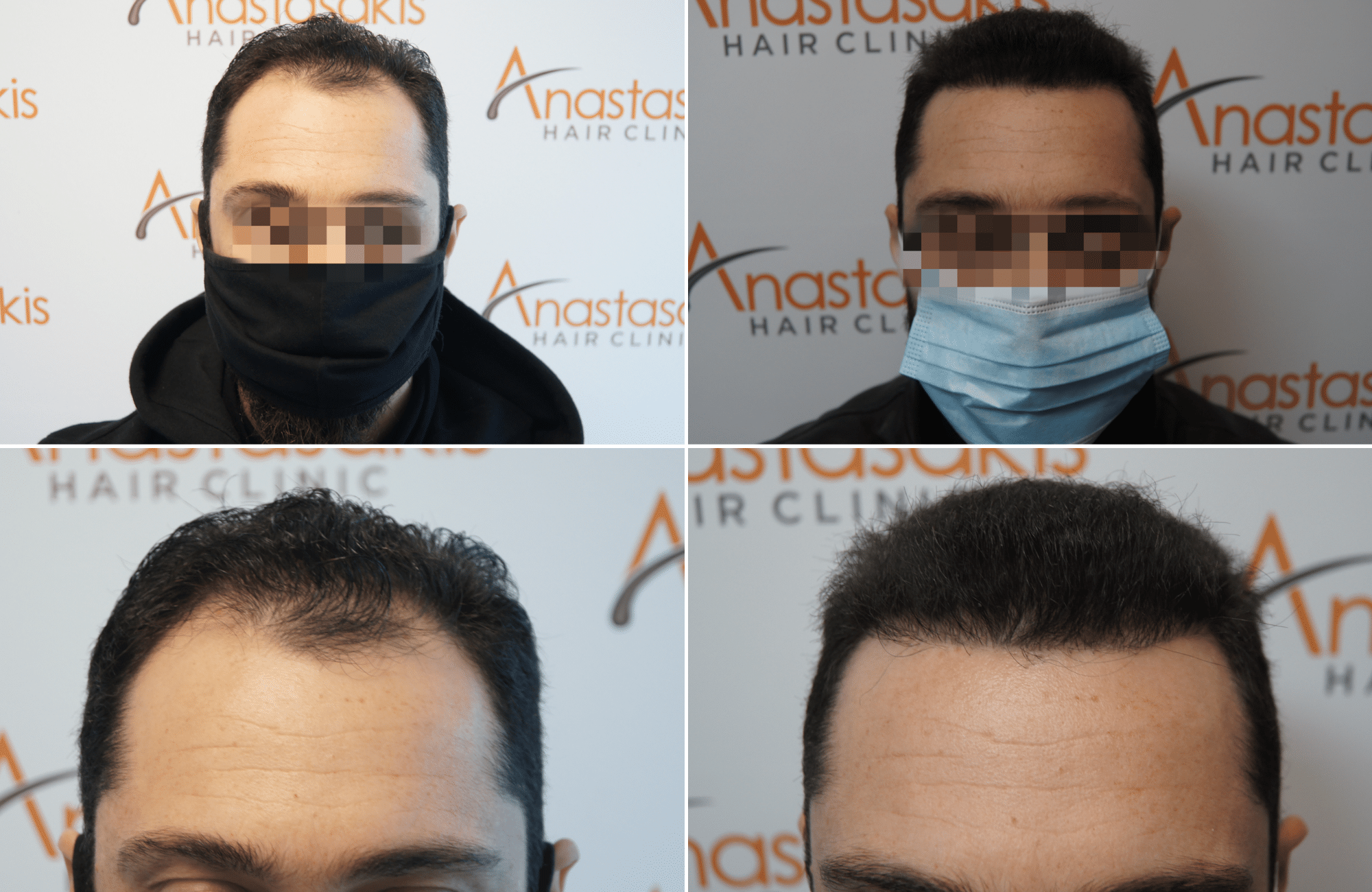 https://www.anastasakishairclinic.gr/portfolio/apotelesma-metamosxefsis-mallion-anastasakis-hair-clinic-341/