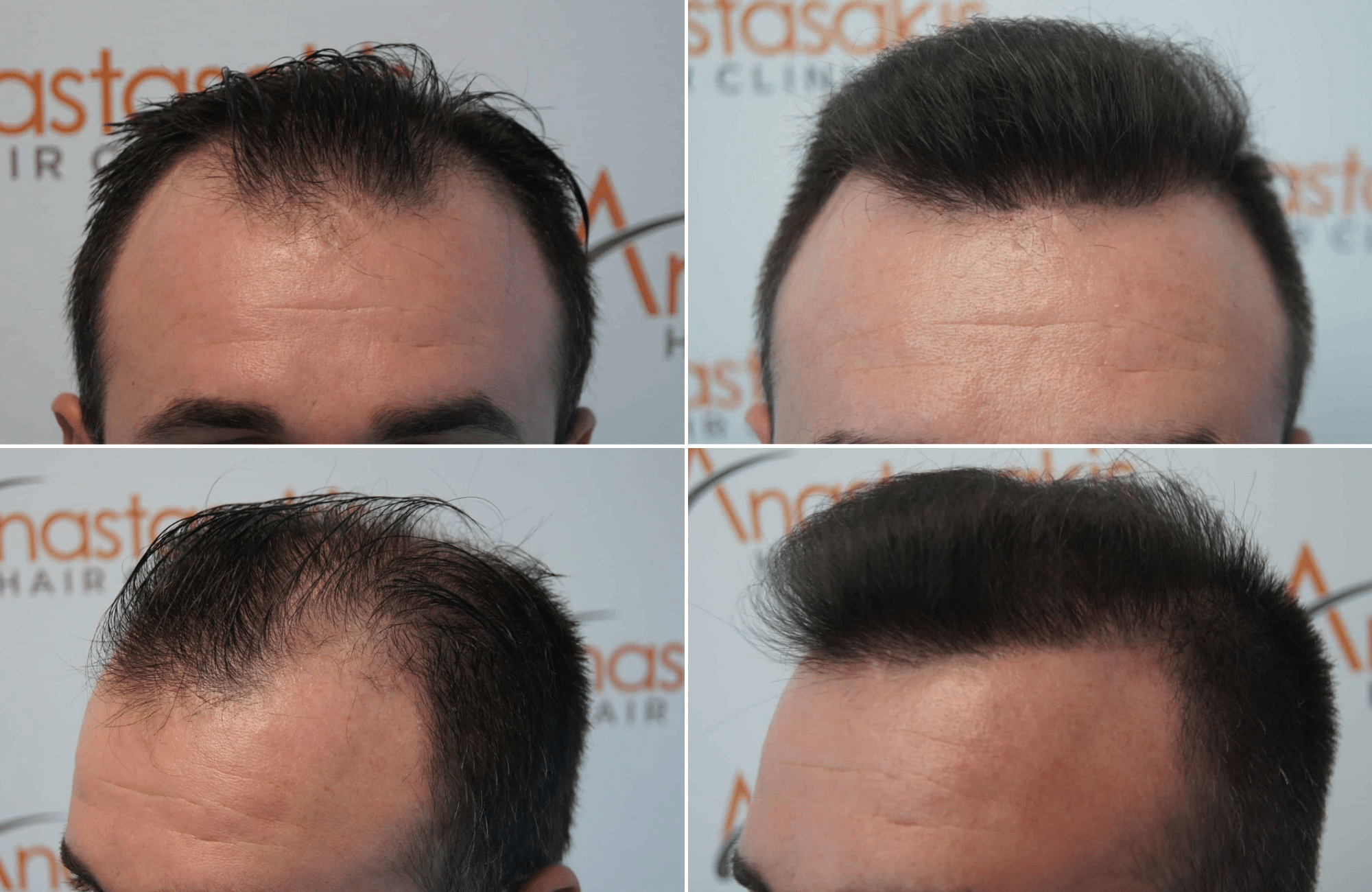 https://www.anastasakishairclinic.gr/portfolio/apotelesma-metamosxefsis-mallion-anastasakis-hair-clinic-342/
