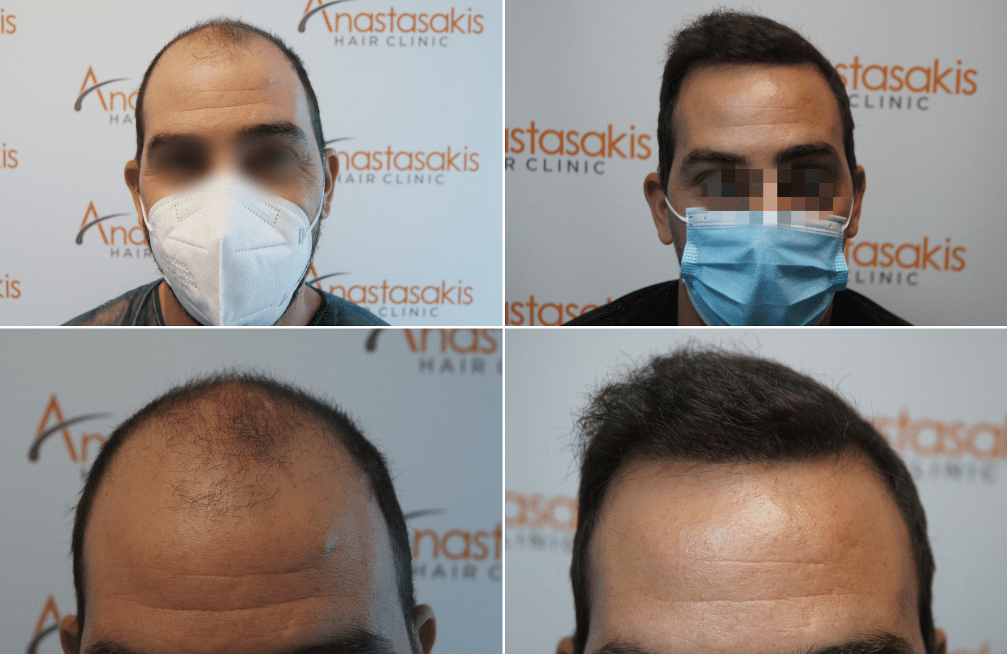 https://www.anastasakishairclinic.gr/portfolio/apotelesma-metamosxefsis-mallion-anastasakis-hair-clinic-344/