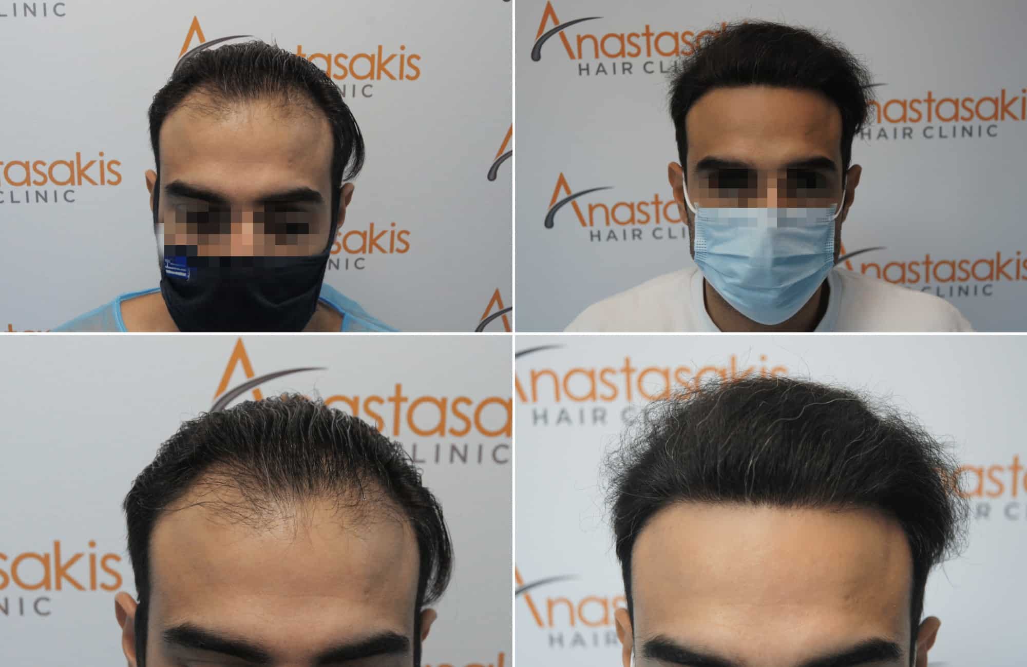 https://www.anastasakishairclinic.gr/portfolio/apotelesma-metamosxefsis-mallion-anastasakis-hair-clinic-345/