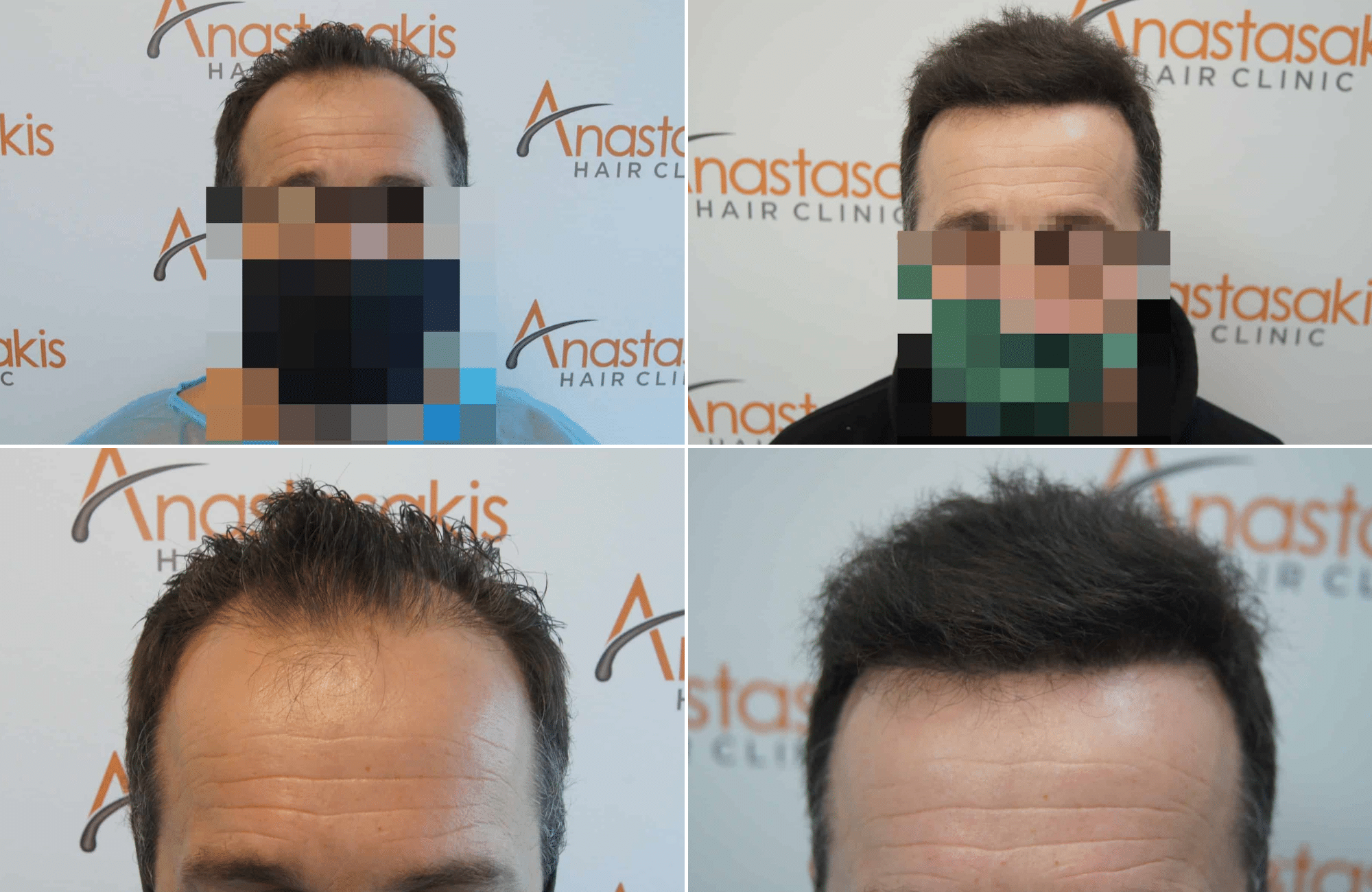 https://www.anastasakishairclinic.gr/portfolio/apotelesma-6minon-2500-fus-fue/