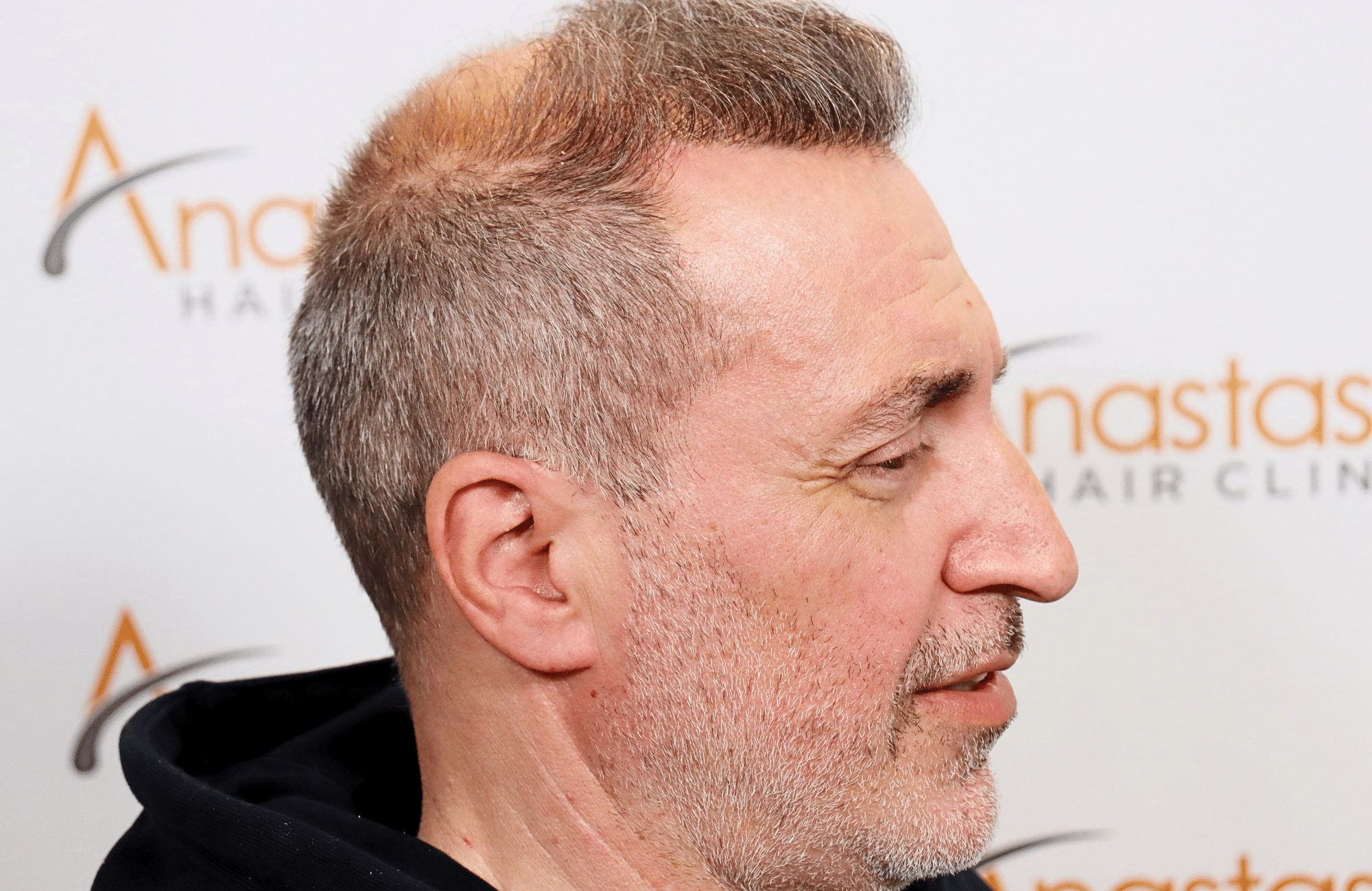 hair transplant result 2600 fus grey 1st stage