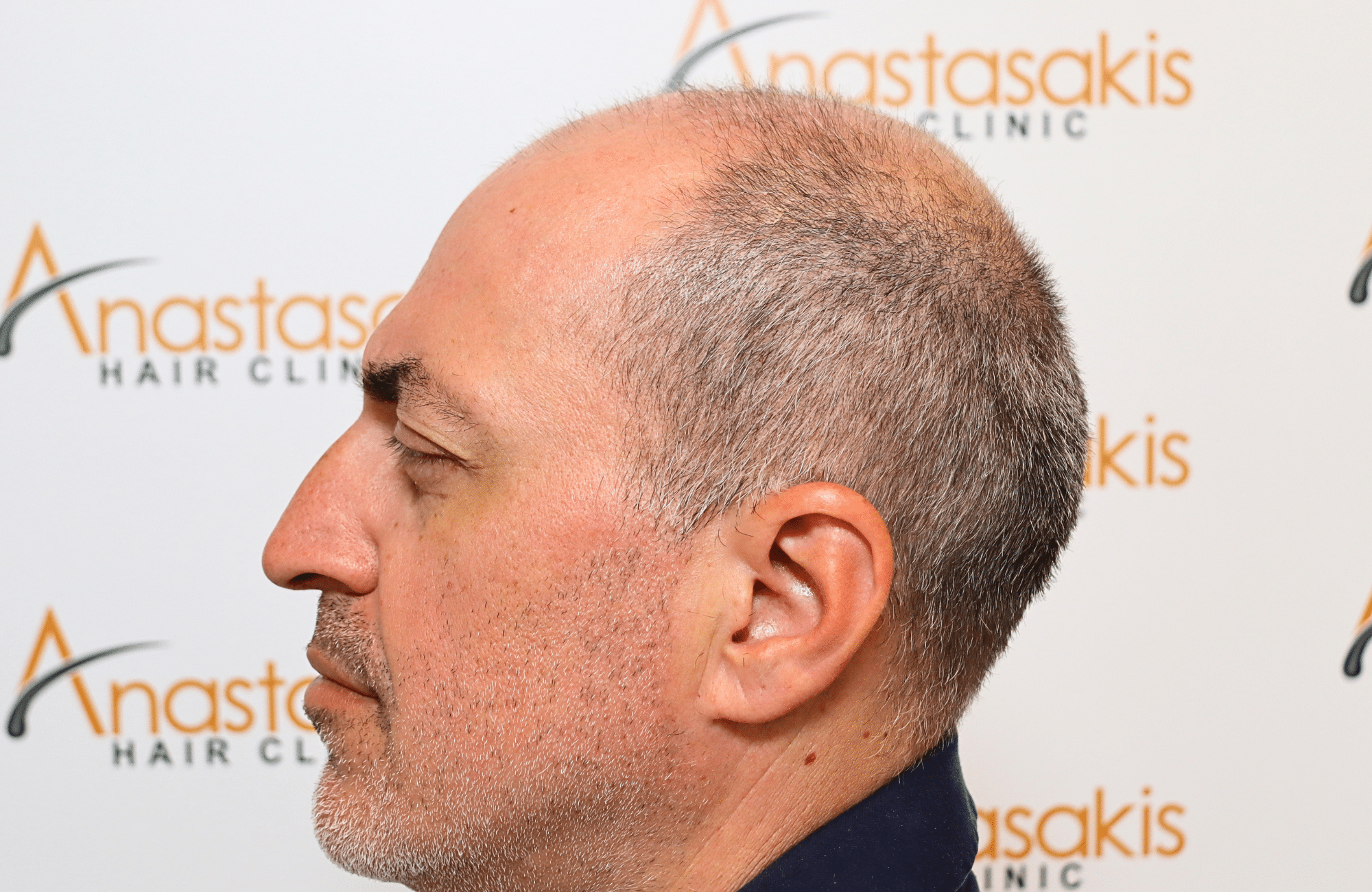 hair transplant result 2600 fus grey 1st stage