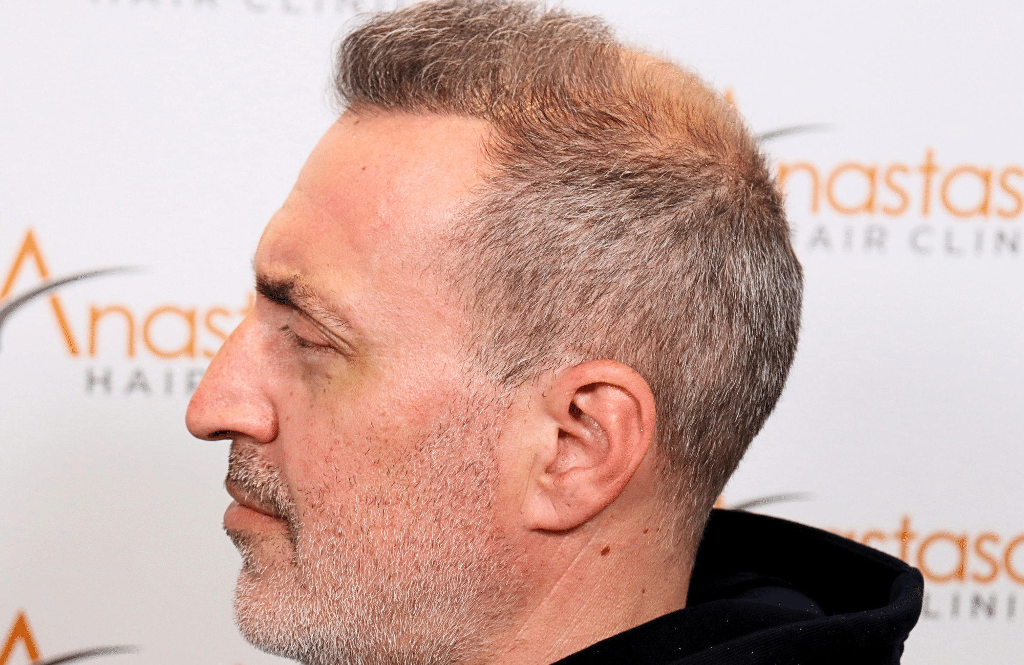 hair transplant result 2600 fus grey 1st stage