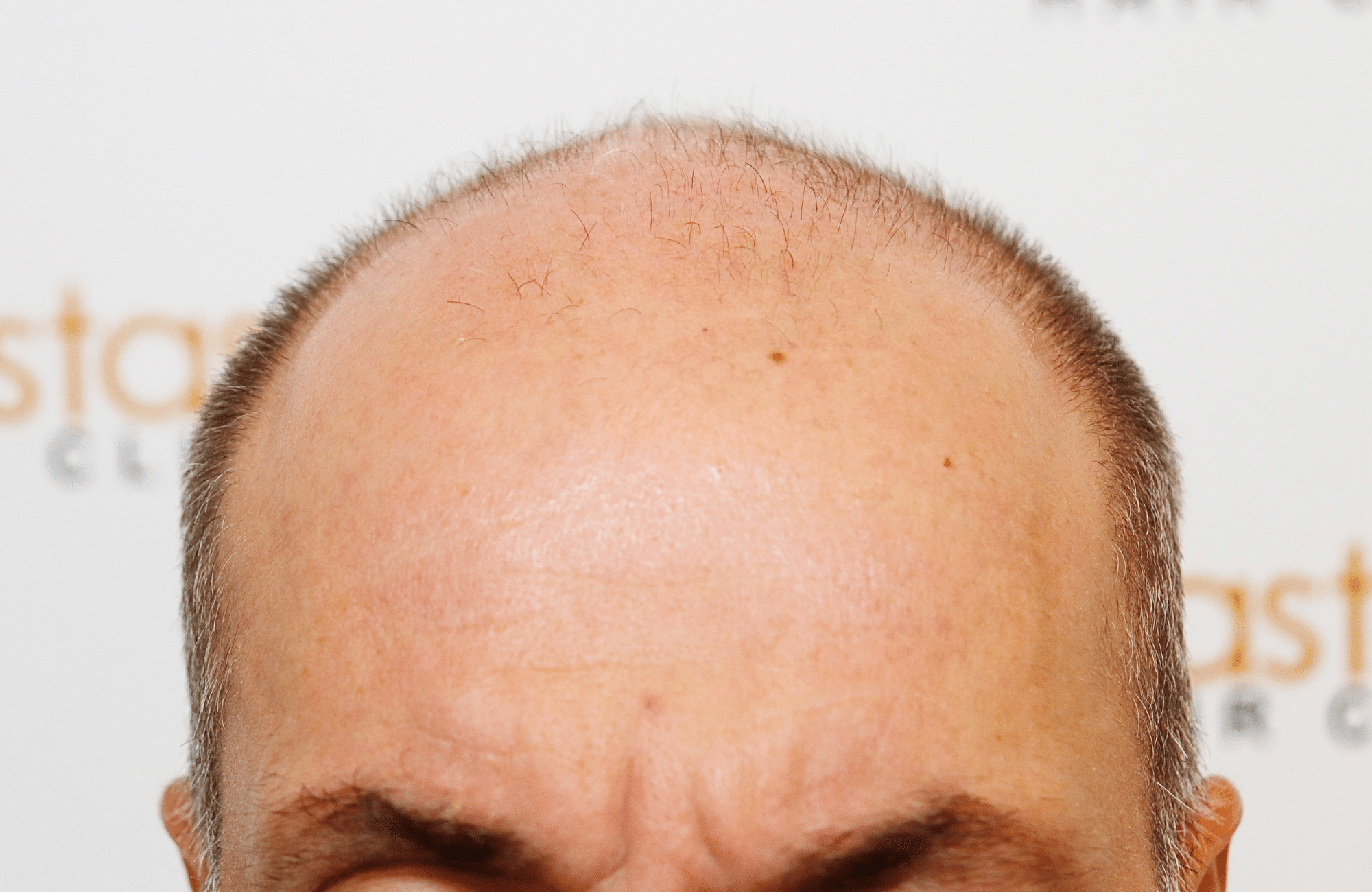 hair transplant result 2600 fus grey 1st stage