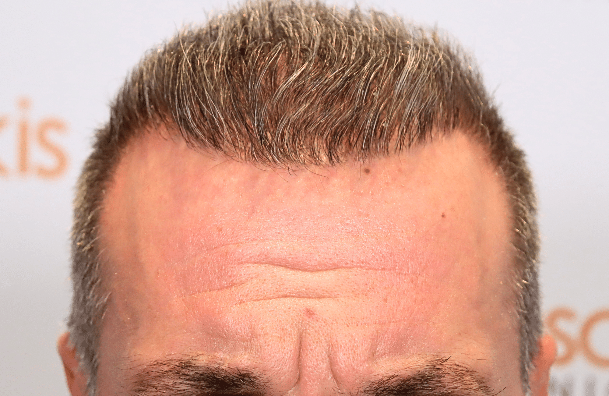 hair transplant result 2600 fus grey 1st stage