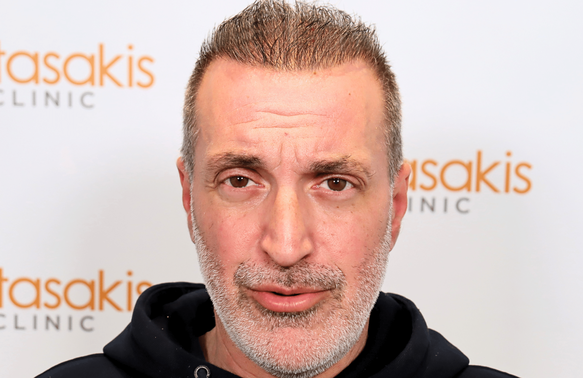 hair transplant result 2600 fus grey 1st stage