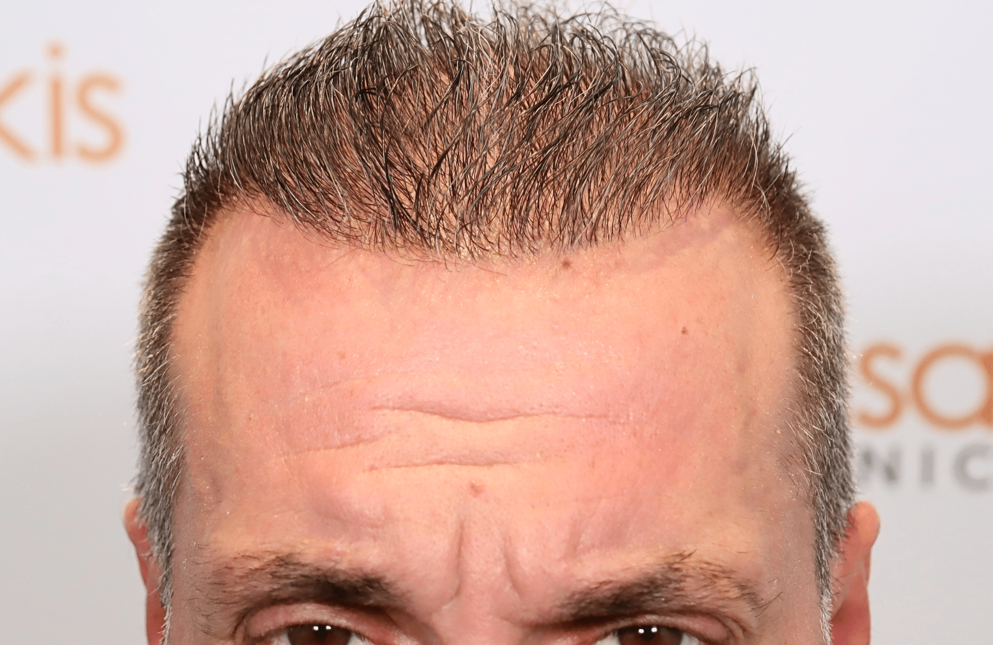 hair transplant result 2600 fus grey 1st stage