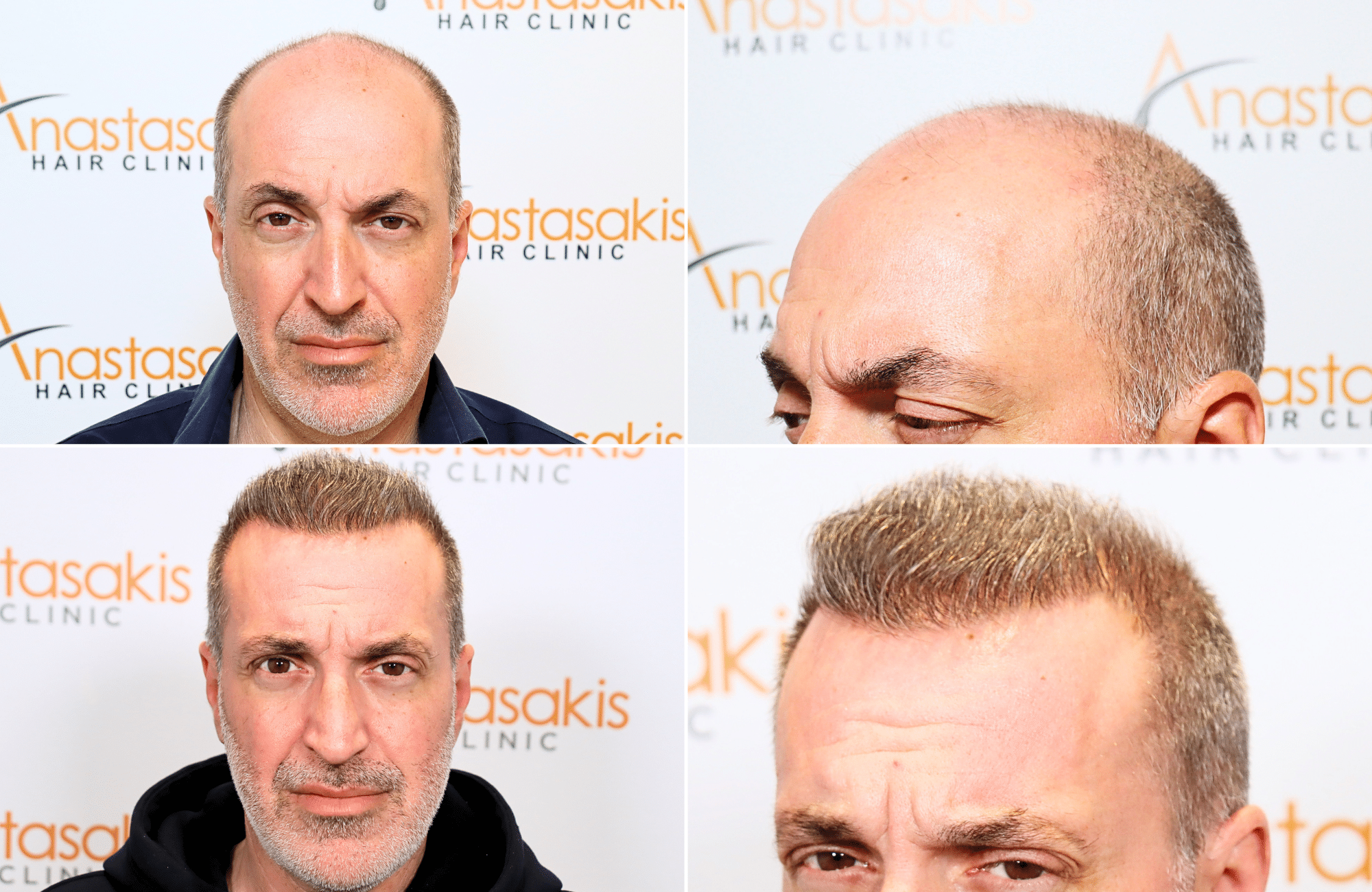 https://www.anastasakishairclinic.gr/portfolio/apotelesma-metamosxefsis-mallion-anastasakis-hair-clinic-56/